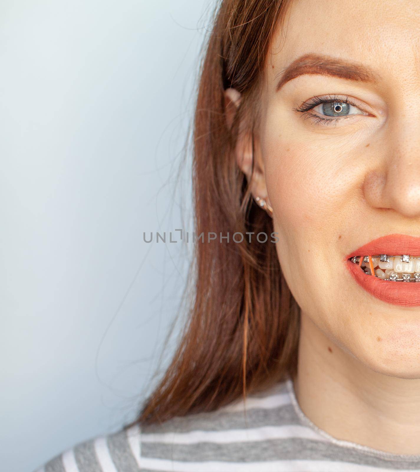 Braces in the smiling mouth of a girl. Close-up photos of teeth and lips. Smooth teeth from braces. On the teeth of elastic bands for tightening teeth. Photo on a light solid background.