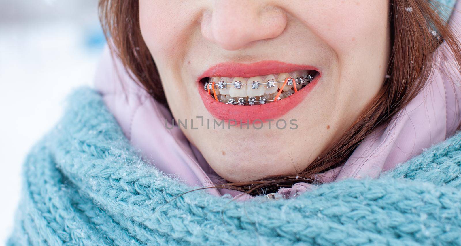 The girl has braces on her teeth. A girl in the winter on the street smiles and braces are visible on her teeth. On the zooms are colored elastic bands to tighten the teeth. Even teeth