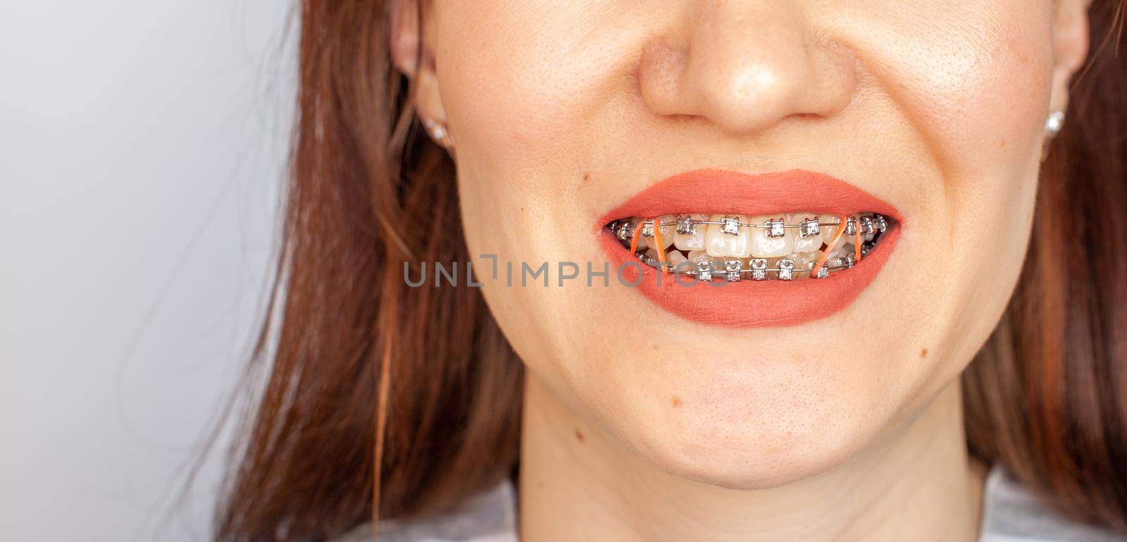 Braces in the smiling mouth of a girl. Smooth teeth from braces. by AnatoliiFoto