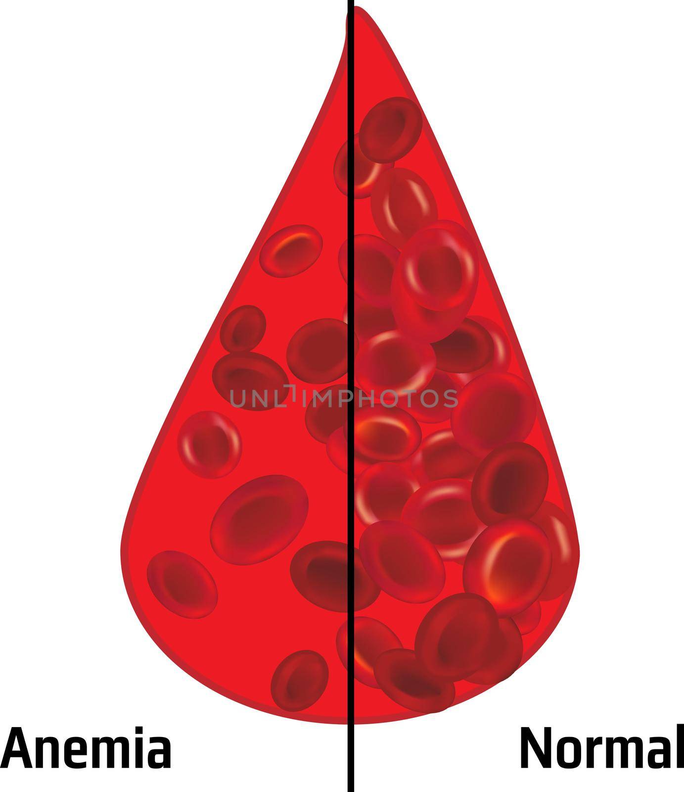 Anemia and normal ammount of red blood cells in a drop of blood vector illustration
