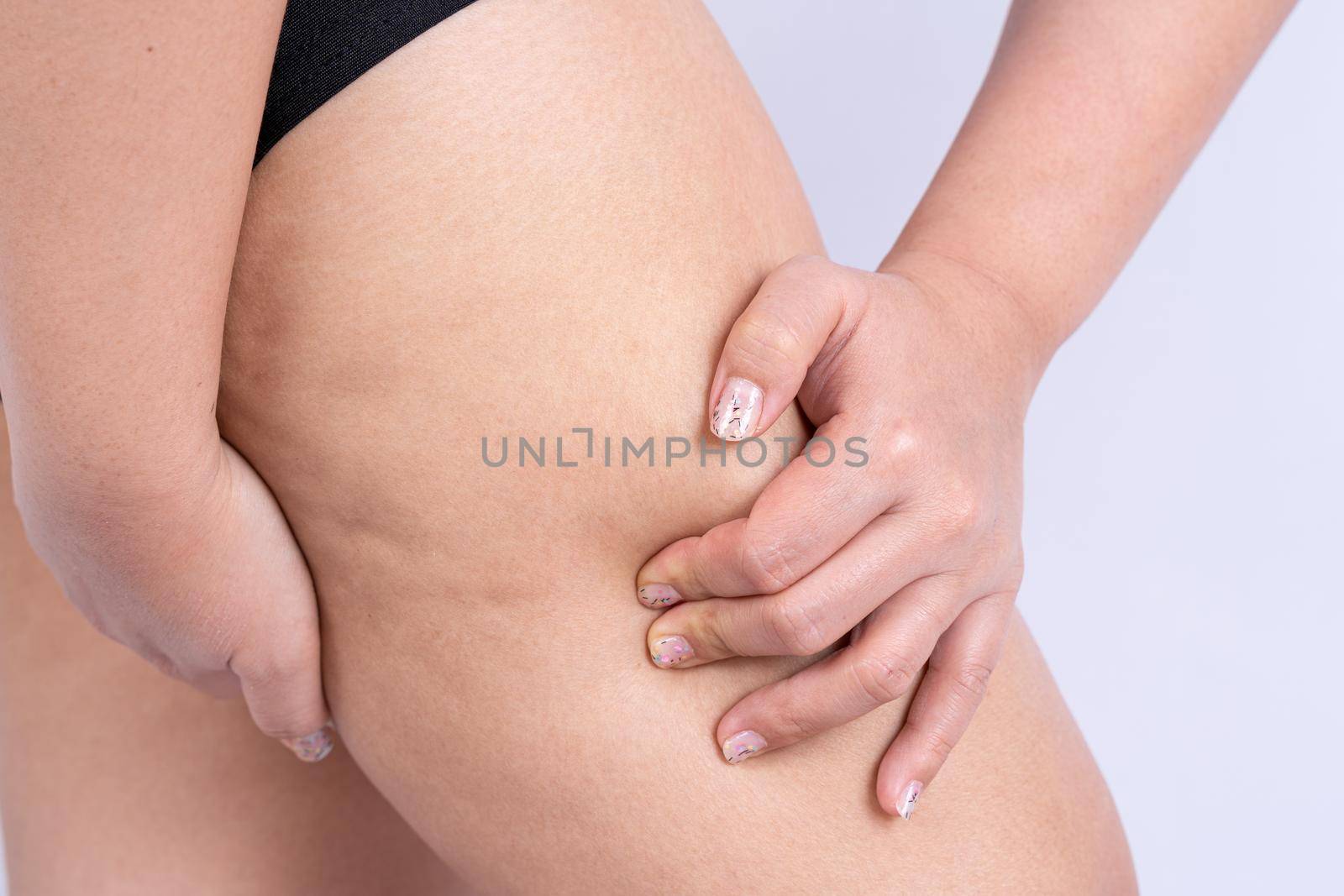 Female holding and pushing the skin of the legs cellulite, orange peel. Treatment and disposal of excess weight, the deposition of subcutaneous fat tissue by mikesaran