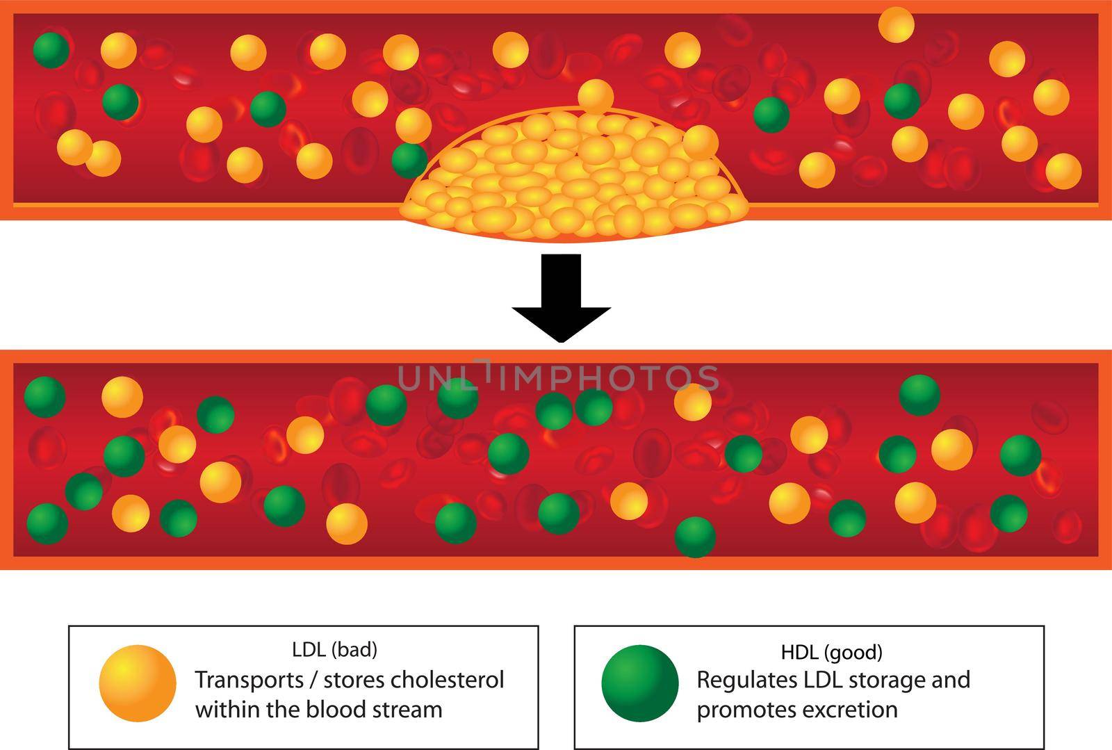 Role of good and bad lipids and levels of atherosclerotic plaque in blood vessel medical vector infographics