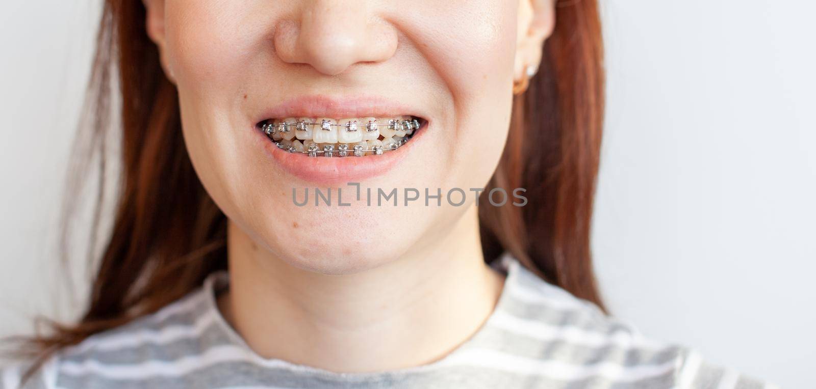 Braces in the smiling mouth of a girl. Close-up photos of teeth and lips. Smooth teeth from braces. On the teeth of elastic bands for tightening teeth. Photo on a light solid background.