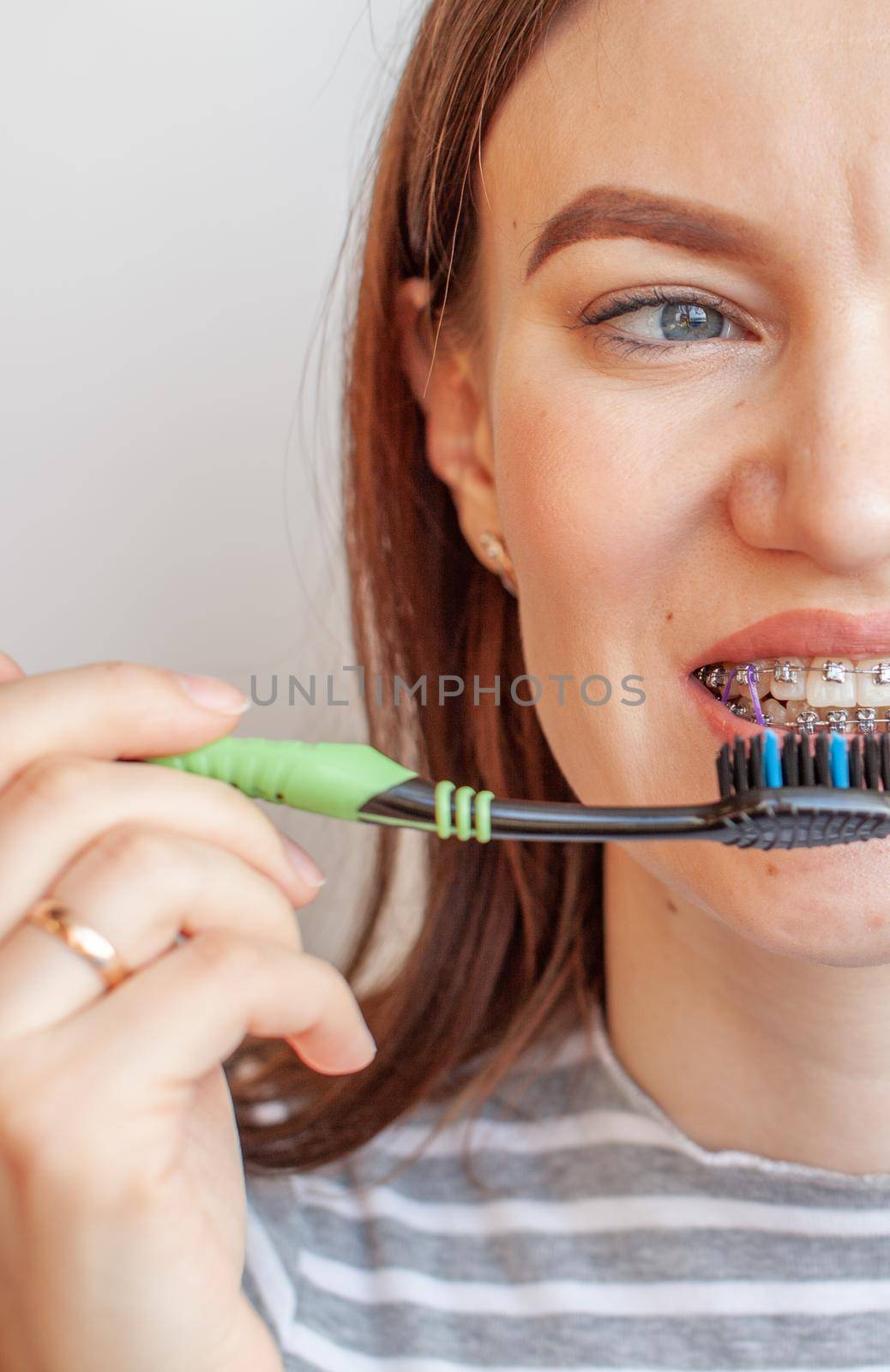A girl with braces on her teeth smiles and holds a toothbrush. by AnatoliiFoto
