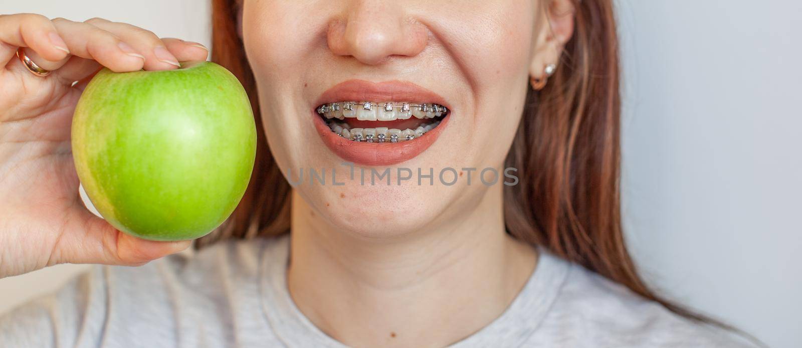 A girl with braces on her teeth wants to bite a green apple. Close-up photos of teeth and lips. Smooth teeth from braces. Photo on a light solid background.