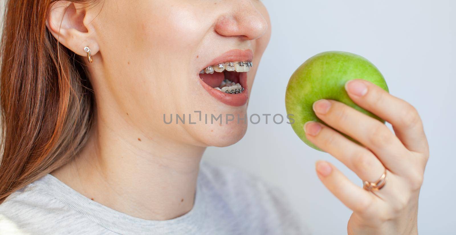A girl with braces on her teeth wants to bite a green apple. Close-up photos of teeth and lips. Smooth teeth from braces. Photo on a light solid background.