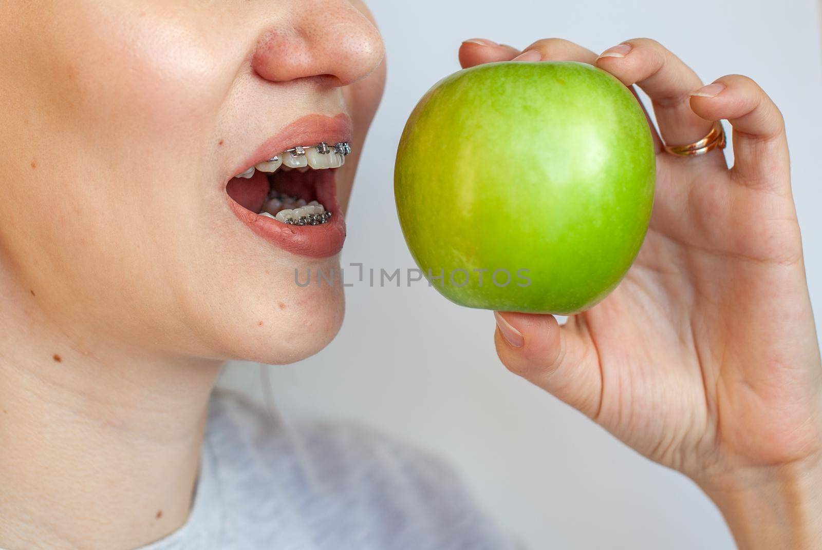 A girl with braces on her teeth wants to bite a green apple. by AnatoliiFoto