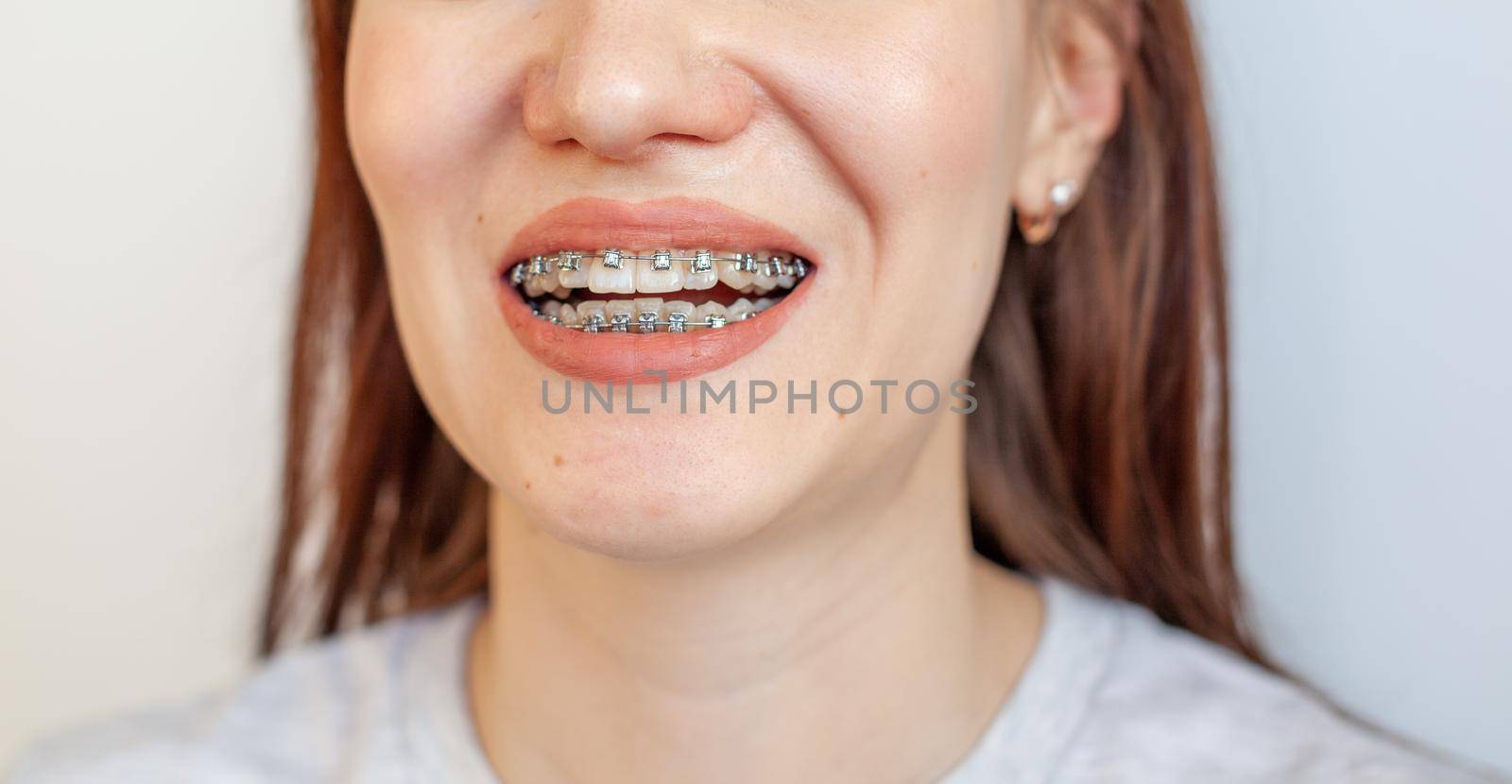 Braces in the smiling mouth of a girl. Close-up photos of teeth and lips. Smooth teeth from braces. On the teeth of elastic bands for tightening teeth. Photo on a light solid background.