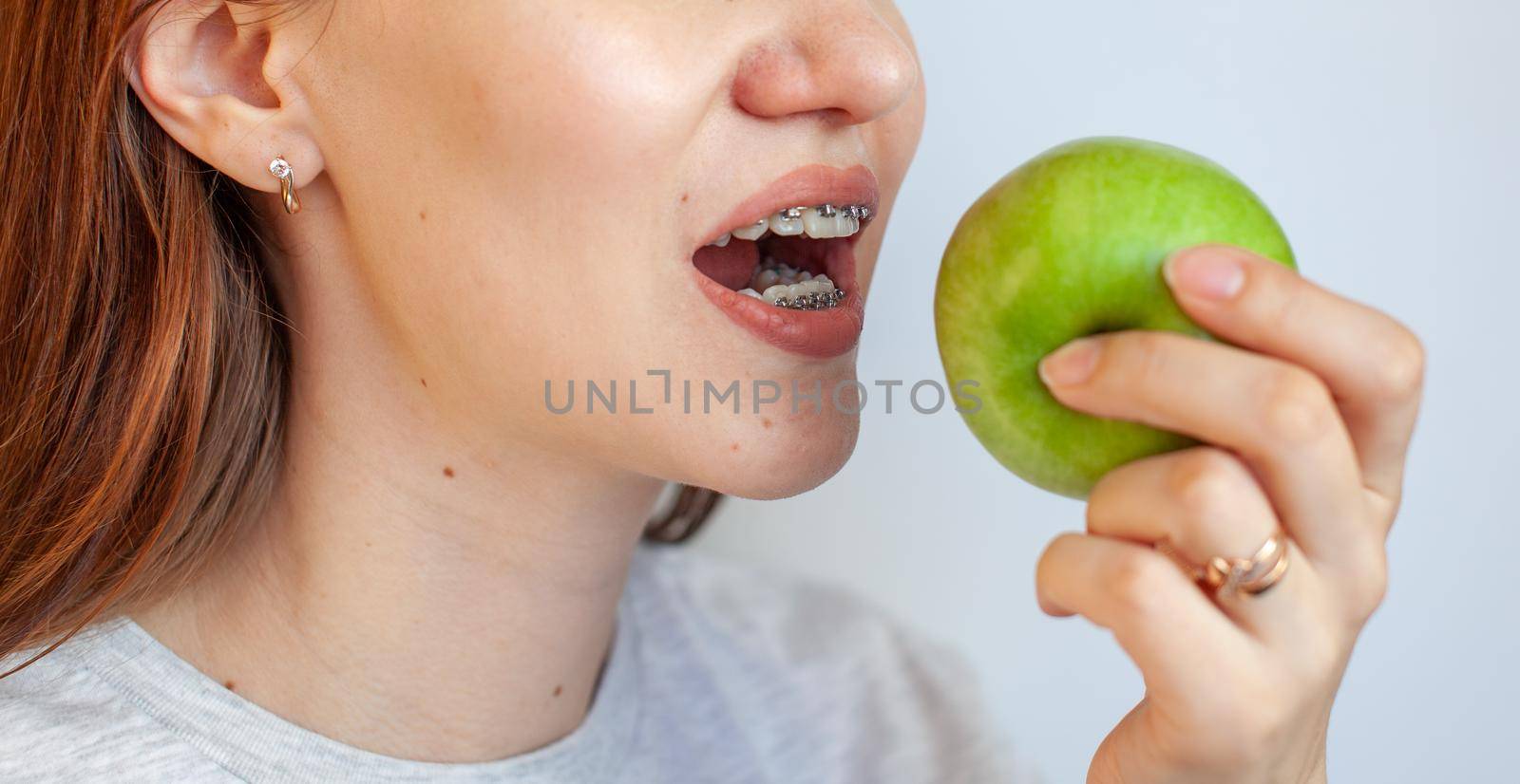 A girl with braces on her teeth wants to bite a green apple. by AnatoliiFoto