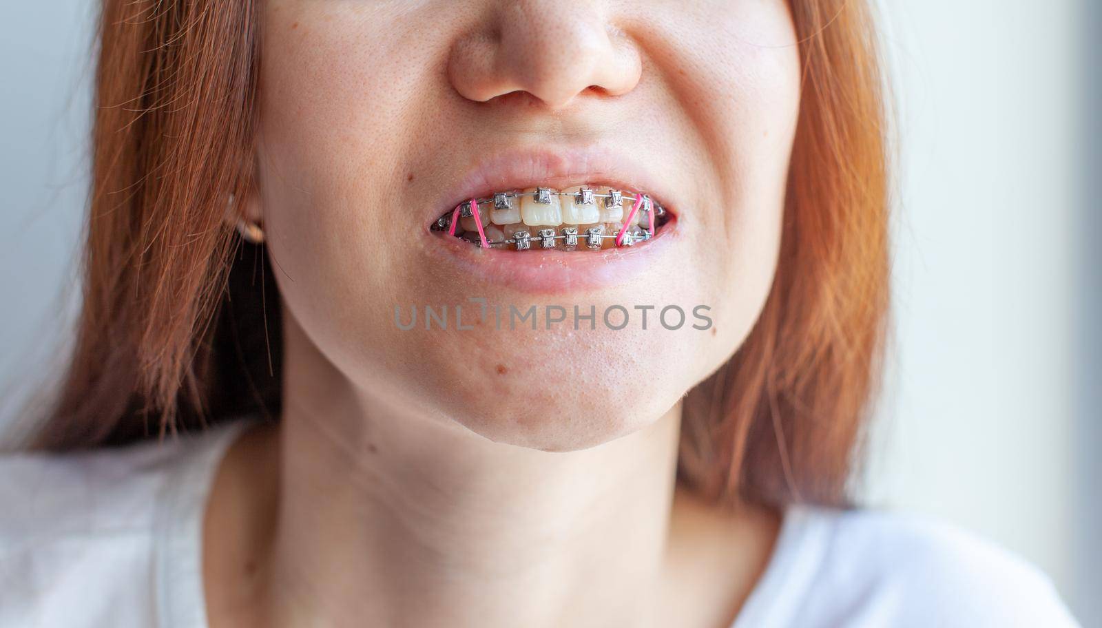 Braces in the smiling mouth of a girl. Close-up photos of teeth and lips. Smooth teeth from braces. On the teeth of elastic bands for tightening teeth. Photo on a light solid background.