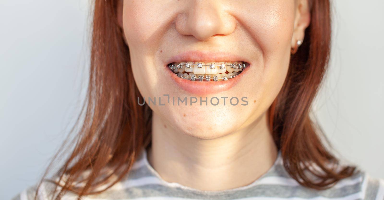 Braces in the smiling mouth of a girl. Close-up photos of teeth and lips. Smooth teeth from braces. On the teeth of elastic bands for tightening teeth. Photo on a light solid background.