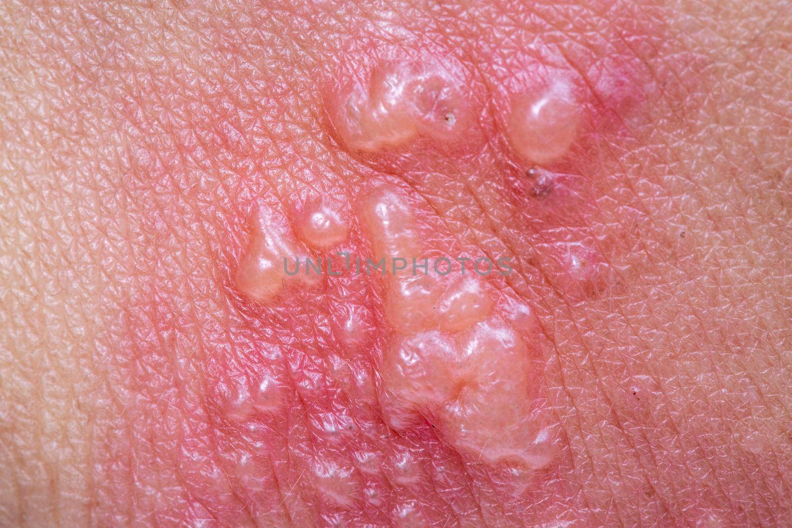 Shingles, Zoster or Herpes Zoster symptoms on arm by toa55
