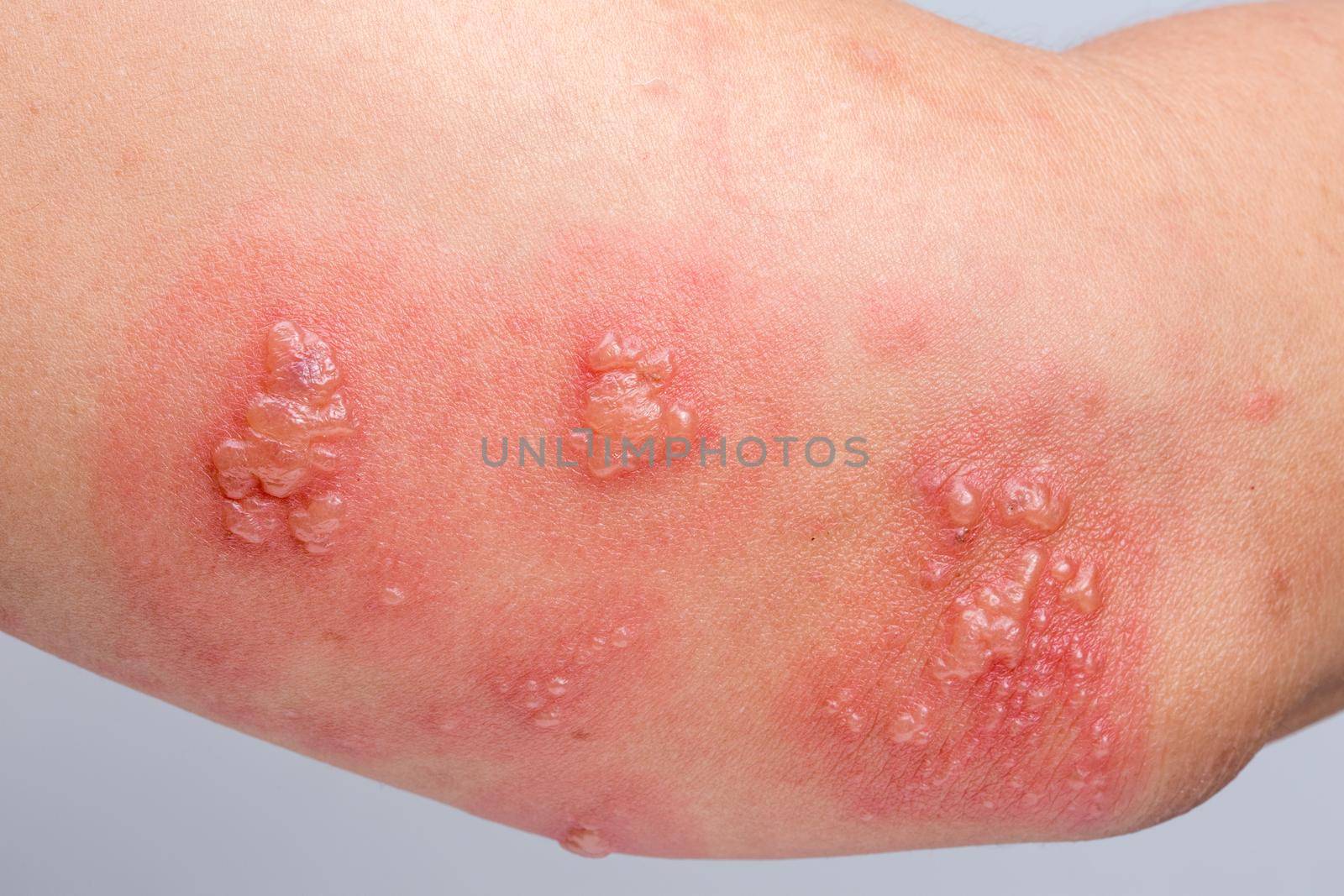 Shingles, Zoster or Herpes Zoster symptoms on arm by toa55