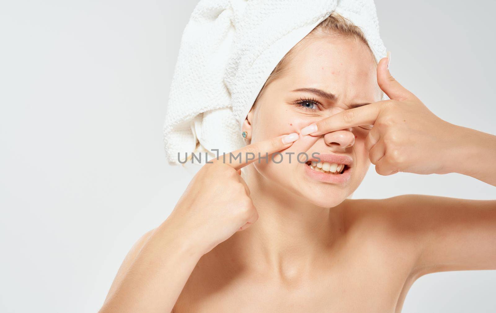 A woman with a towel on her head squeezes out acne on her face problem skin cosmetology dermatology by SHOTPRIME