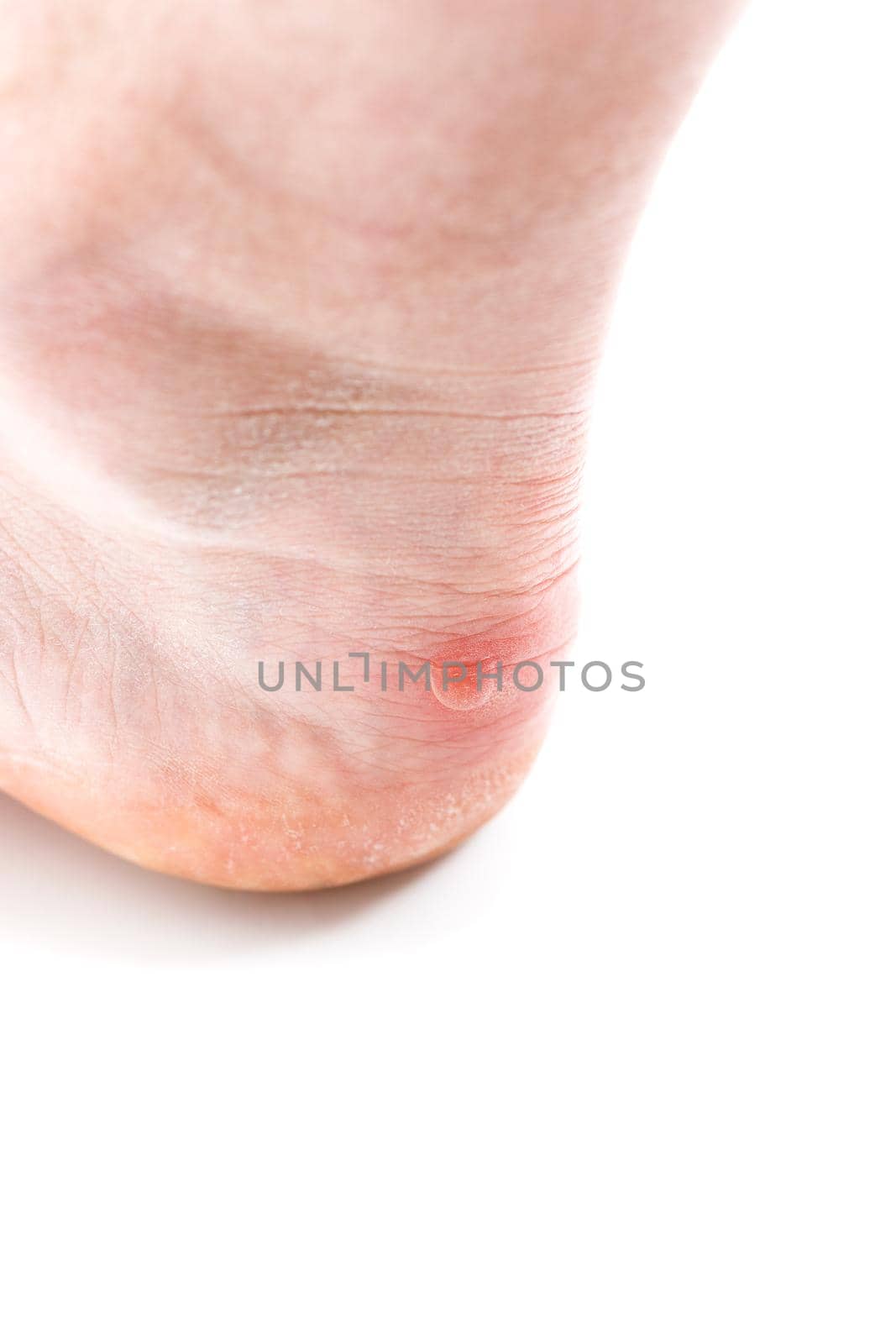 Small unpopped blister on heel, isolated on white background, close-up with selective focus. Caucasian ethnicity.
