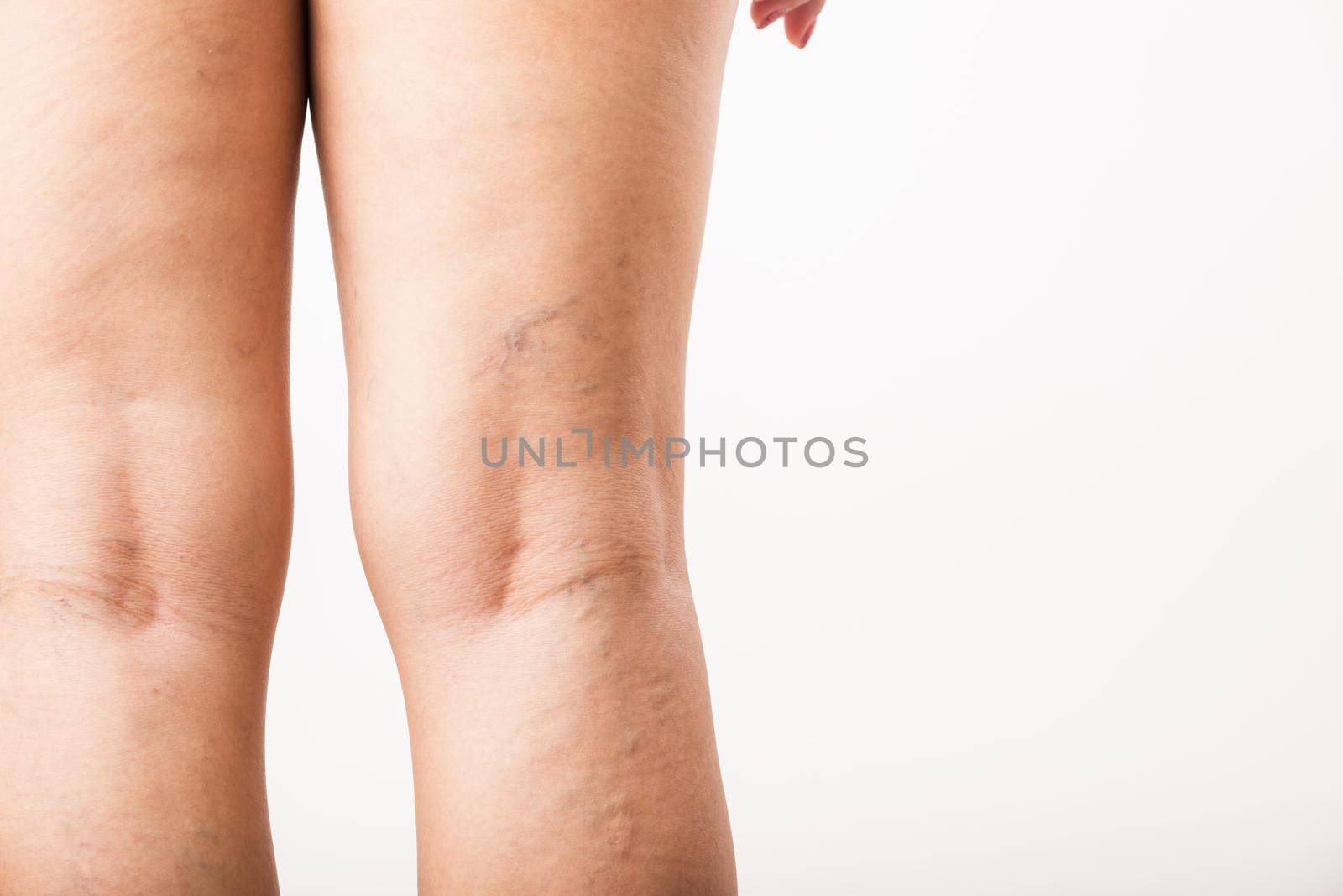 Closeup young Asian woman painful varicose and spider veins on leg, studio shot isolated on white background, Healthcare medical and hygiene skin body varicose veins problems care concept