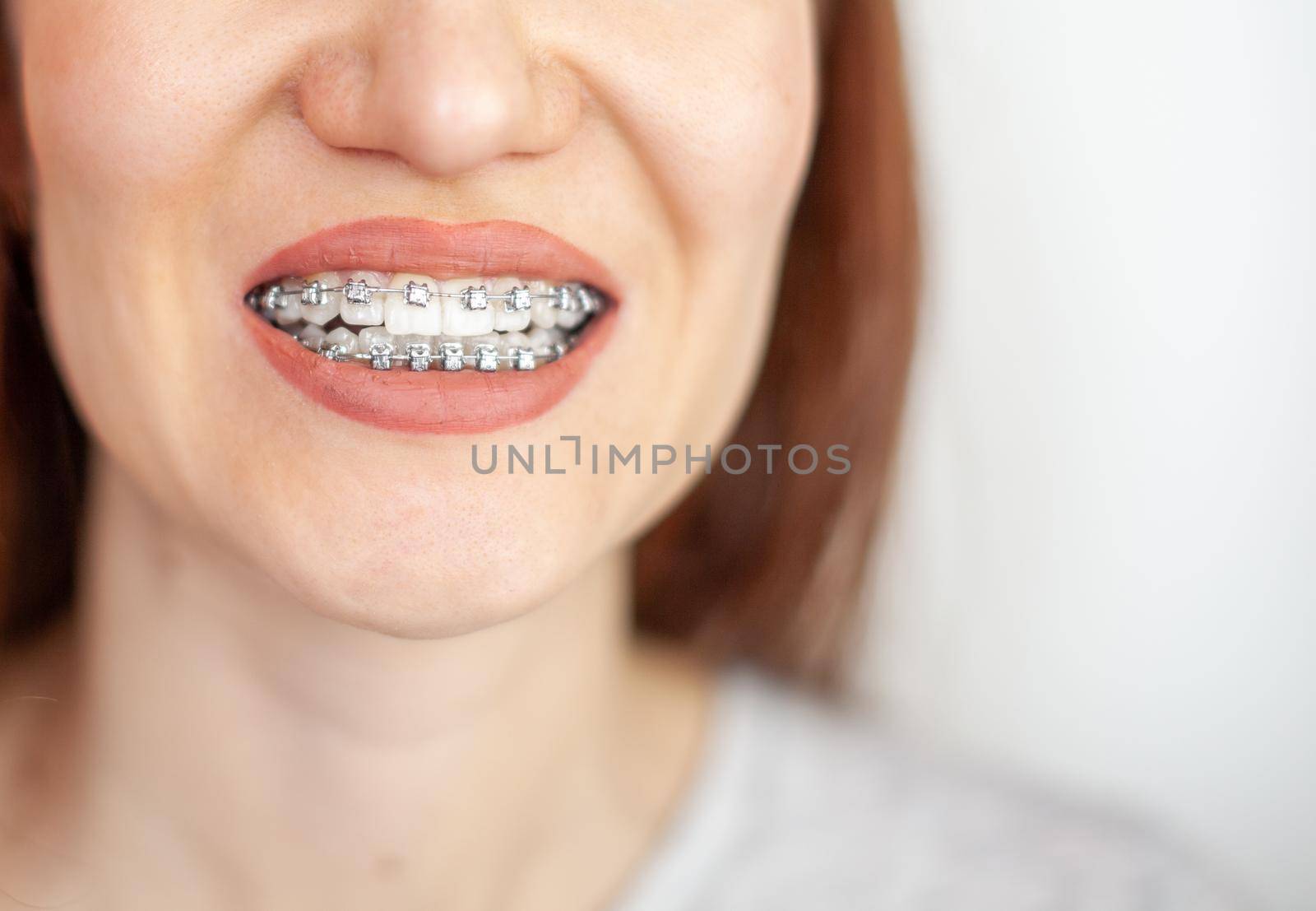 The smile of a young girl with braces on her white teeth. Teeth straightening. by AnatoliiFoto