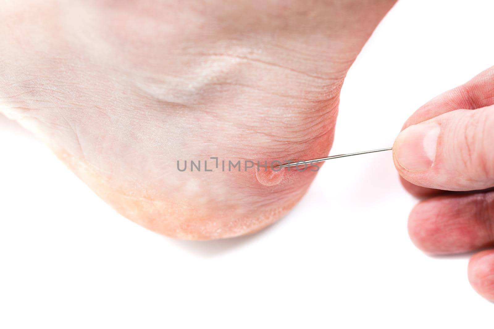Blister on heel gets pricked with sewing needle to burst it on white background, close-up with selective focus.