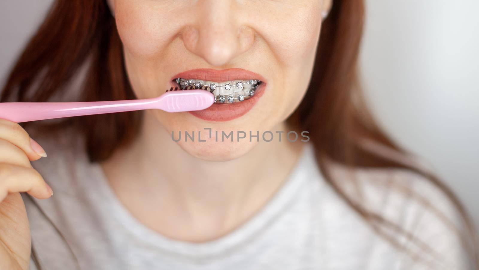 A girl with braces on her white teeth and a toothbrush by AnatoliiFoto