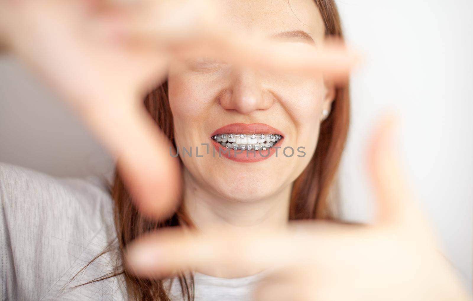A girl with braces on her white teeth through a frame from her hands. by AnatoliiFoto