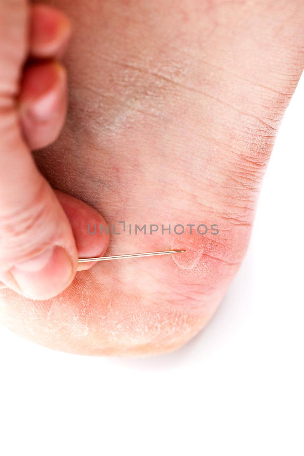 Blister on heel gets pricked with sewing needle to burst it on white background, close-up with selective focus.