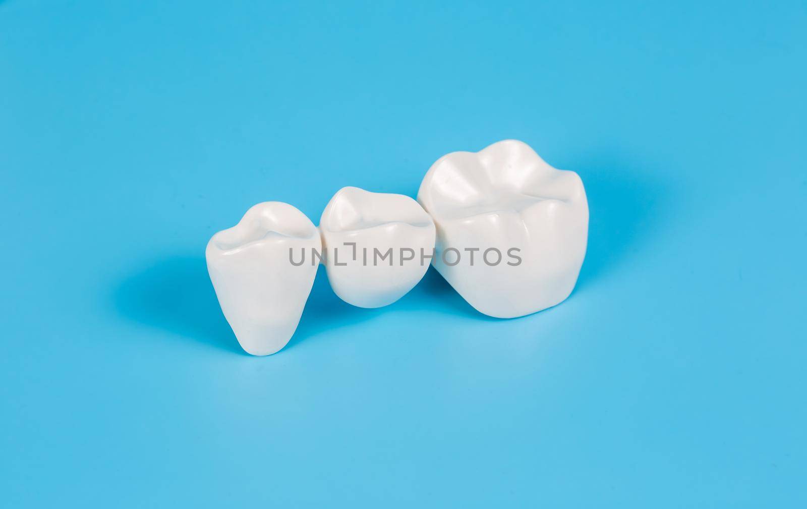 Plastic dental crowns, imitation of a dental prosthesis of a dental bridge for three teeth on a blue background.Visual aid for dentists and patients.