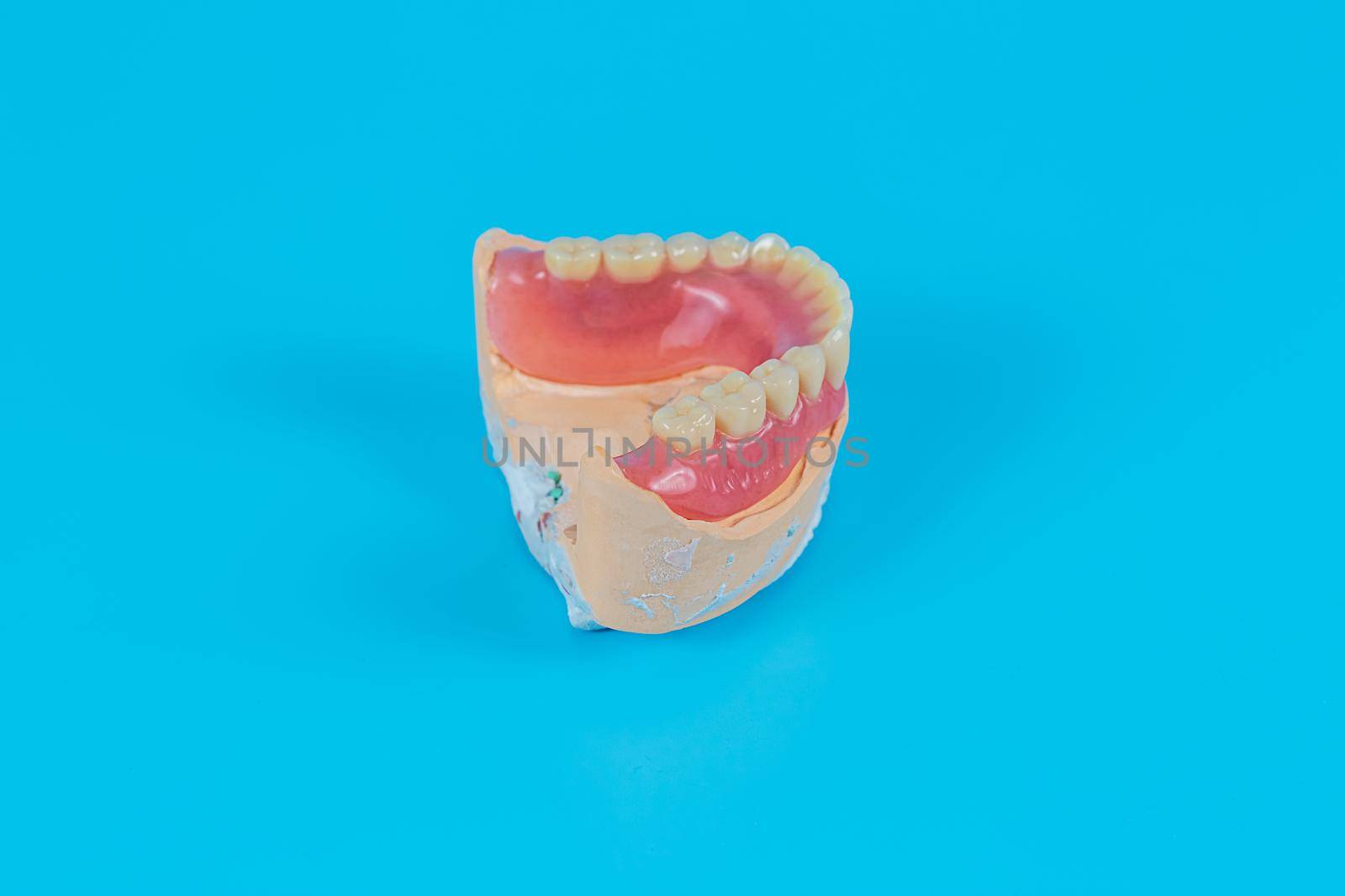 Artificial jaw, visual aid for dentists and patients on a blue background. by galinasharapova