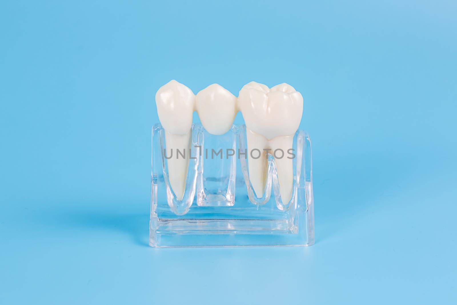 Plastic dental crowns, imitation of a dental prosthesis of a dental bridge for one tooth on a blue background.Visual aid for dentists and patients.