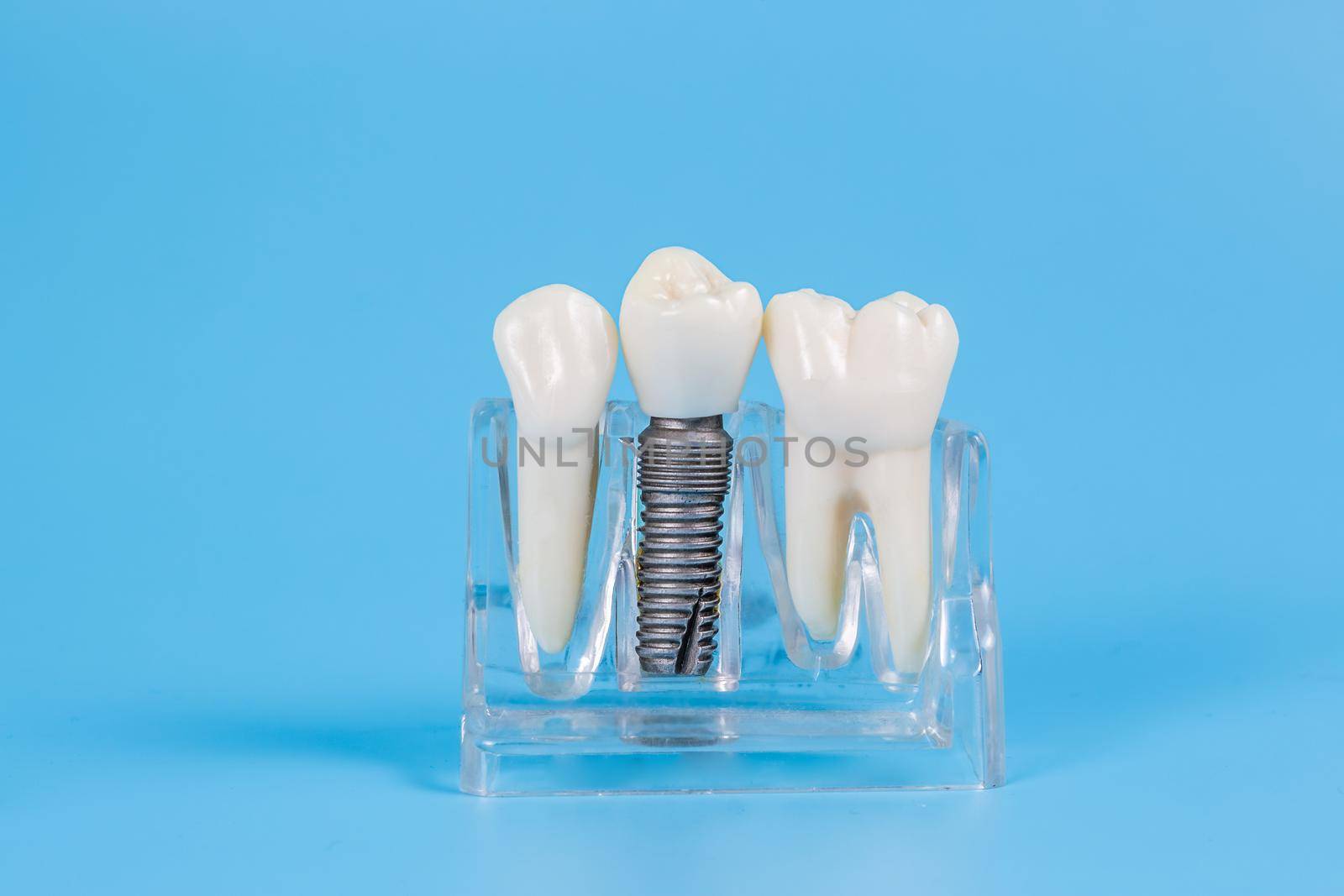 Dental crowns, imitation of a dental prosthesis of a dental bridge with implant by galinasharapova