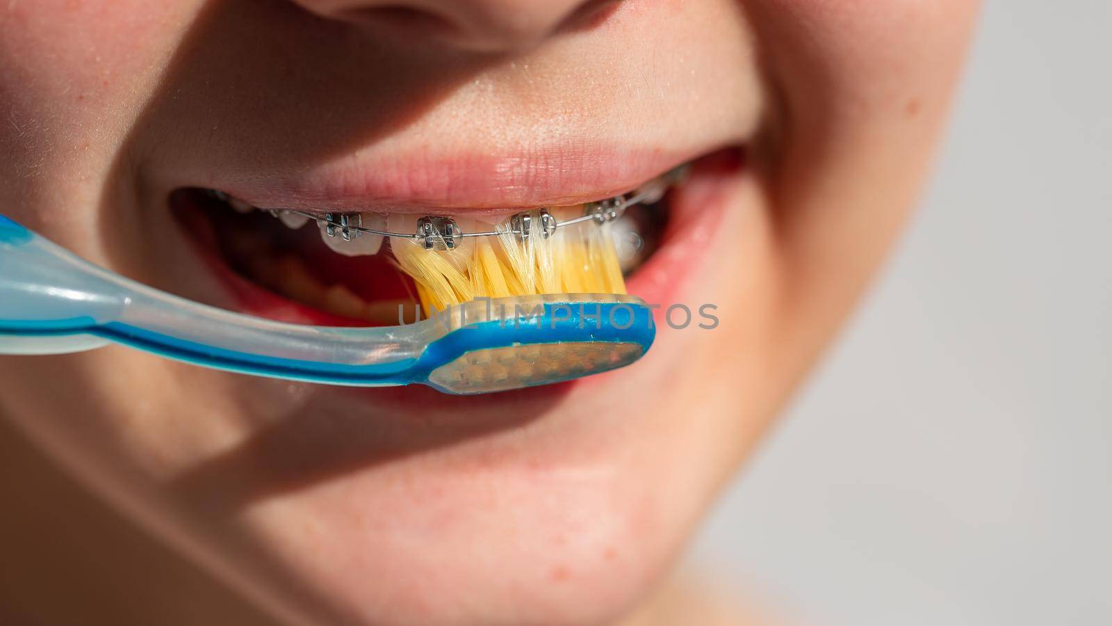 Close up of a teenage girl smiling in orthodontic brackets. Girl with braces on teeth. Orthodontic Treatment.