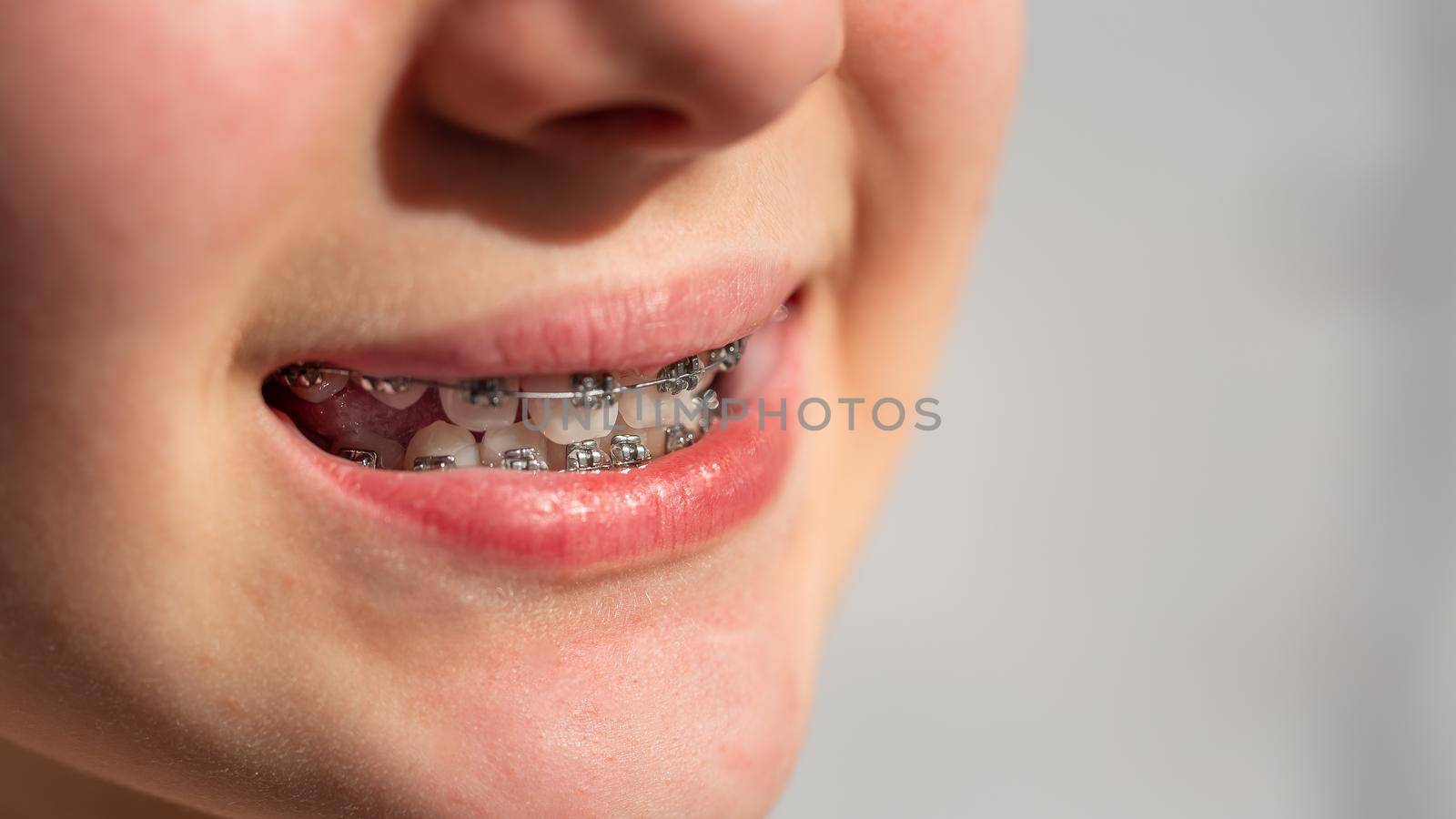 Close up of a teenage girl smiling in orthodontic brackets. Girl with braces on teeth. by Len44ik