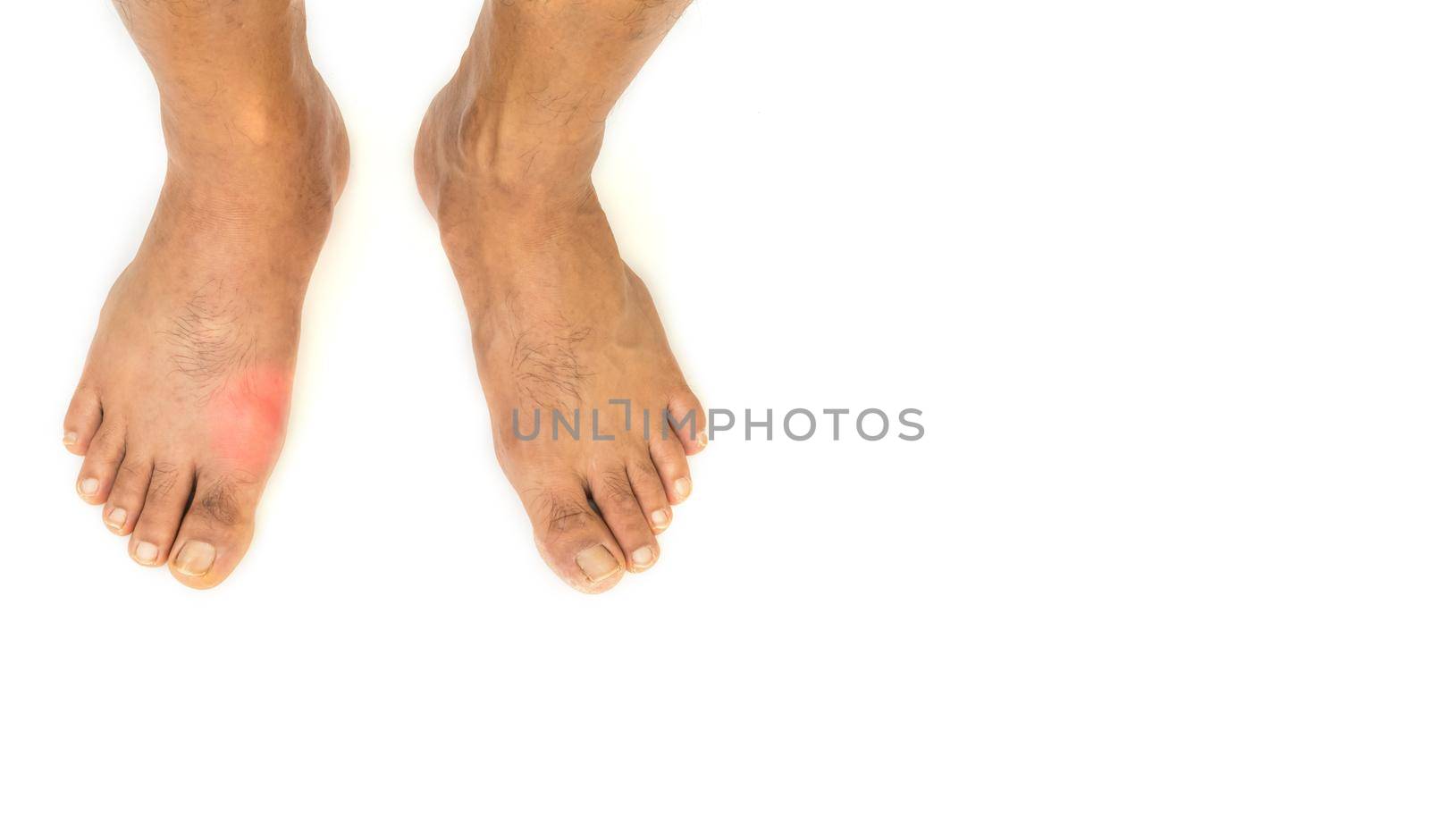 Foot disease Rheumatism and gout. by suththisumdeang