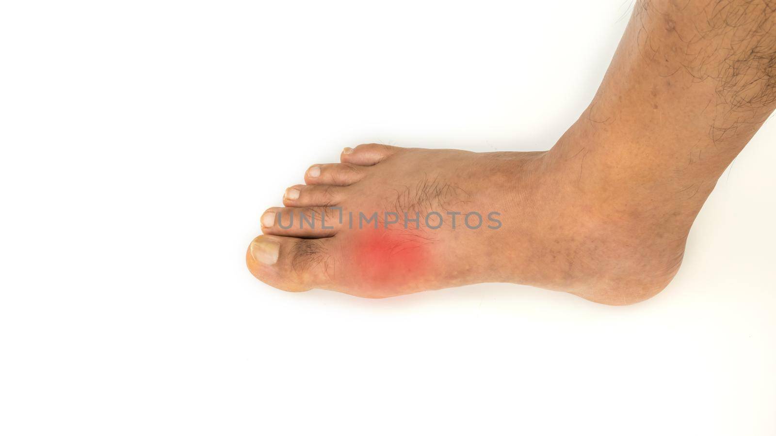 Foot disease Rheumatism and gout. by suththisumdeang