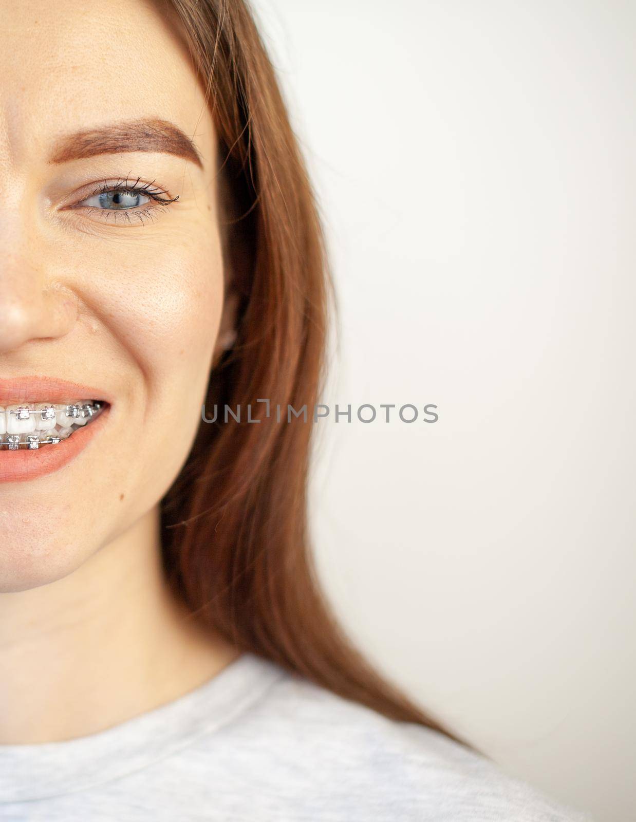 The smile of a young girl with braces on her white teeth. Teeth straightening. by AnatoliiFoto