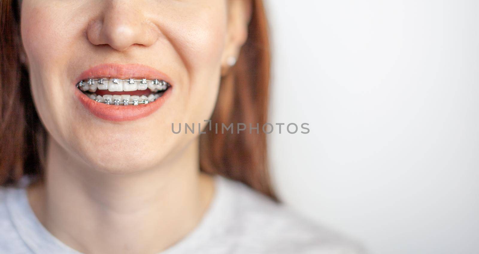The smile of a young girl with braces on her white teeth. Teeth straightening. Malocclusion. Dental care. 