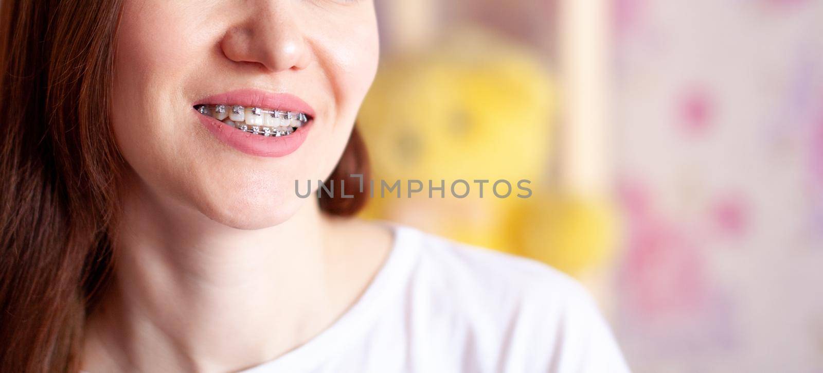 The smile of a young girl with braces on her white teeth. Teeth straightening. Malocclusion. Dental care. 