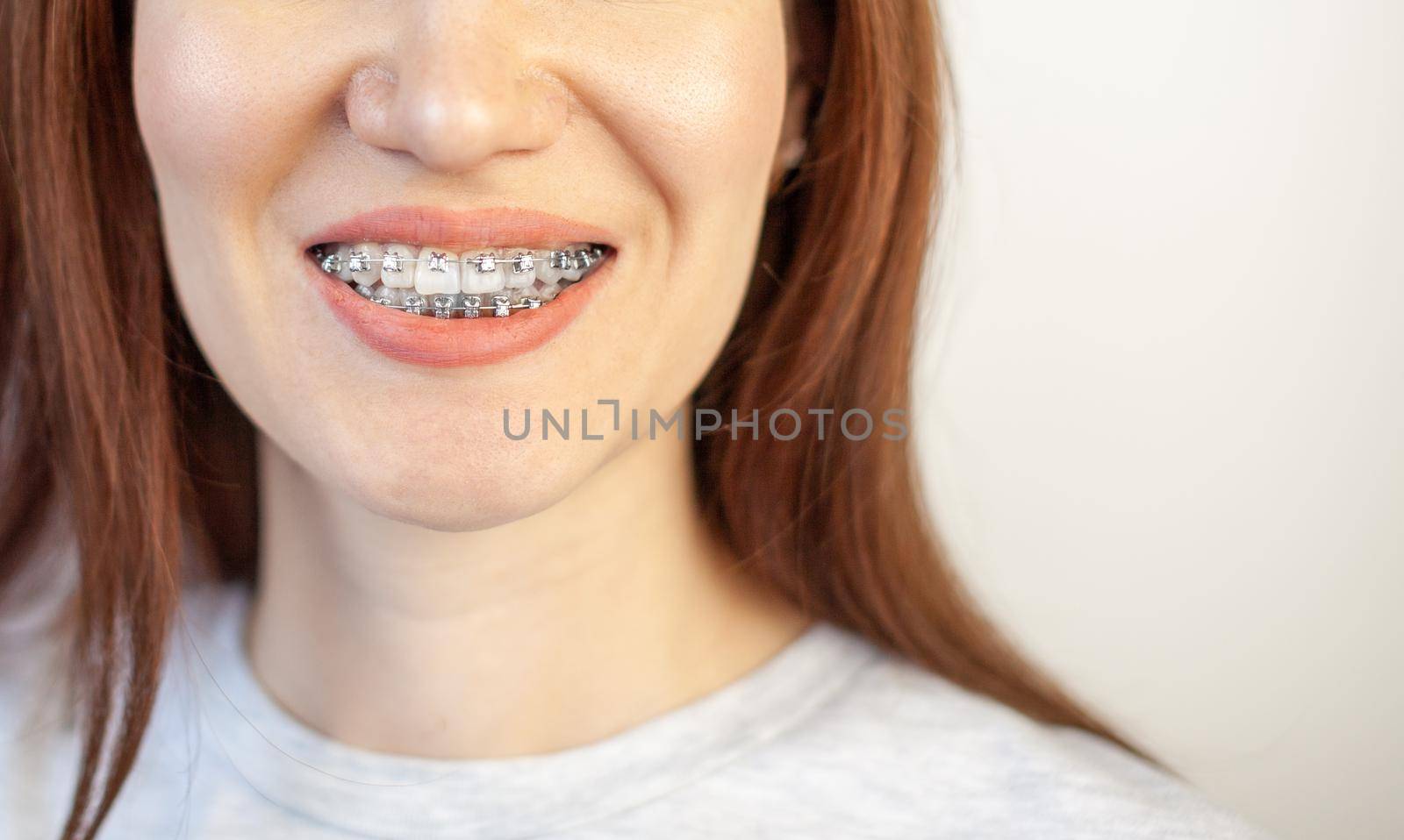 The smile of a young girl with braces on her white teeth. Teeth straightening. Malocclusion. Dental care.