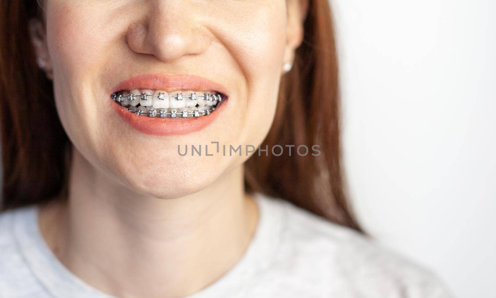 The smile of a young girl with braces on her white teeth. Teeth straightening. by AnatoliiFoto