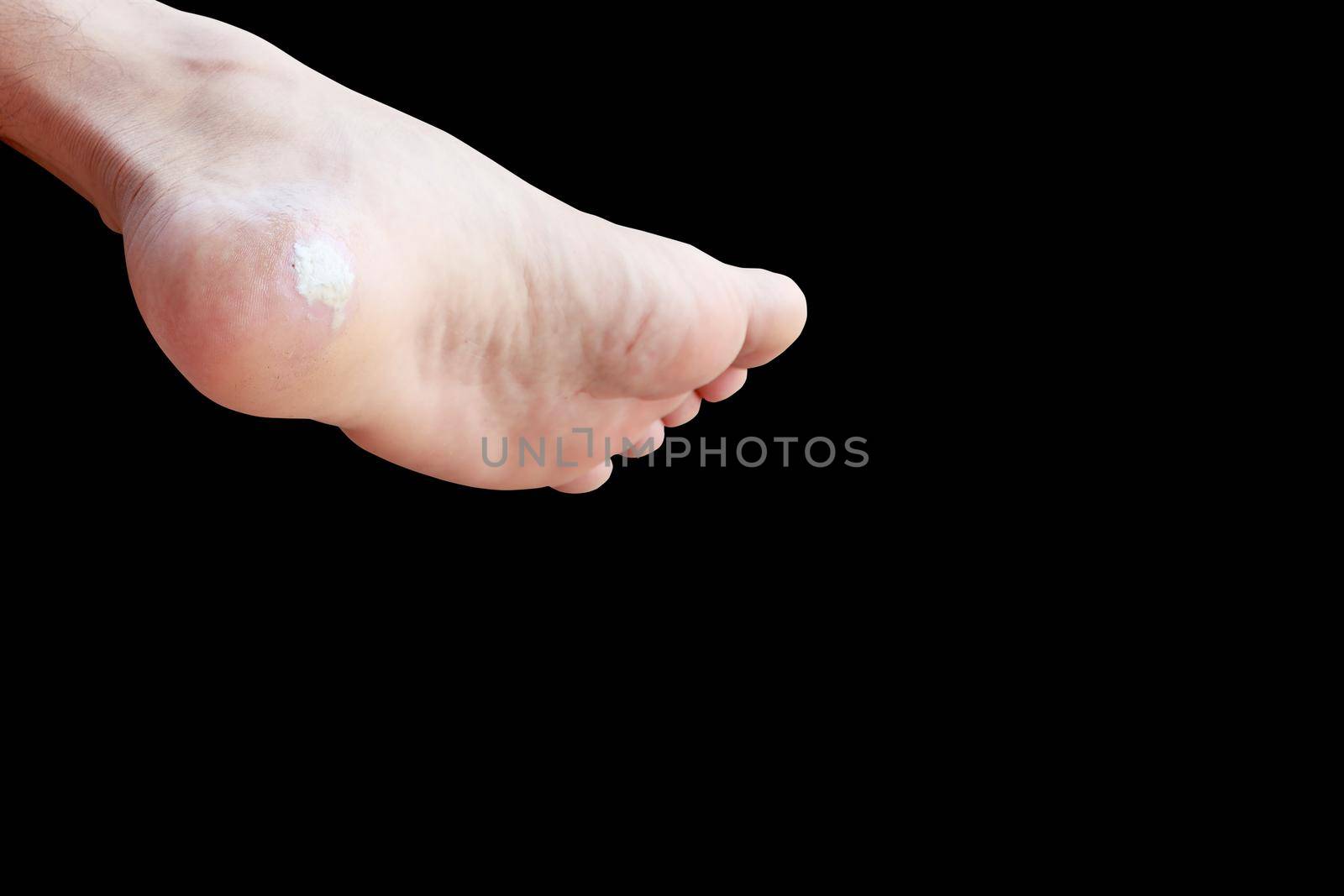 close up pain foot corn isolated on black background with clipping path by pramot