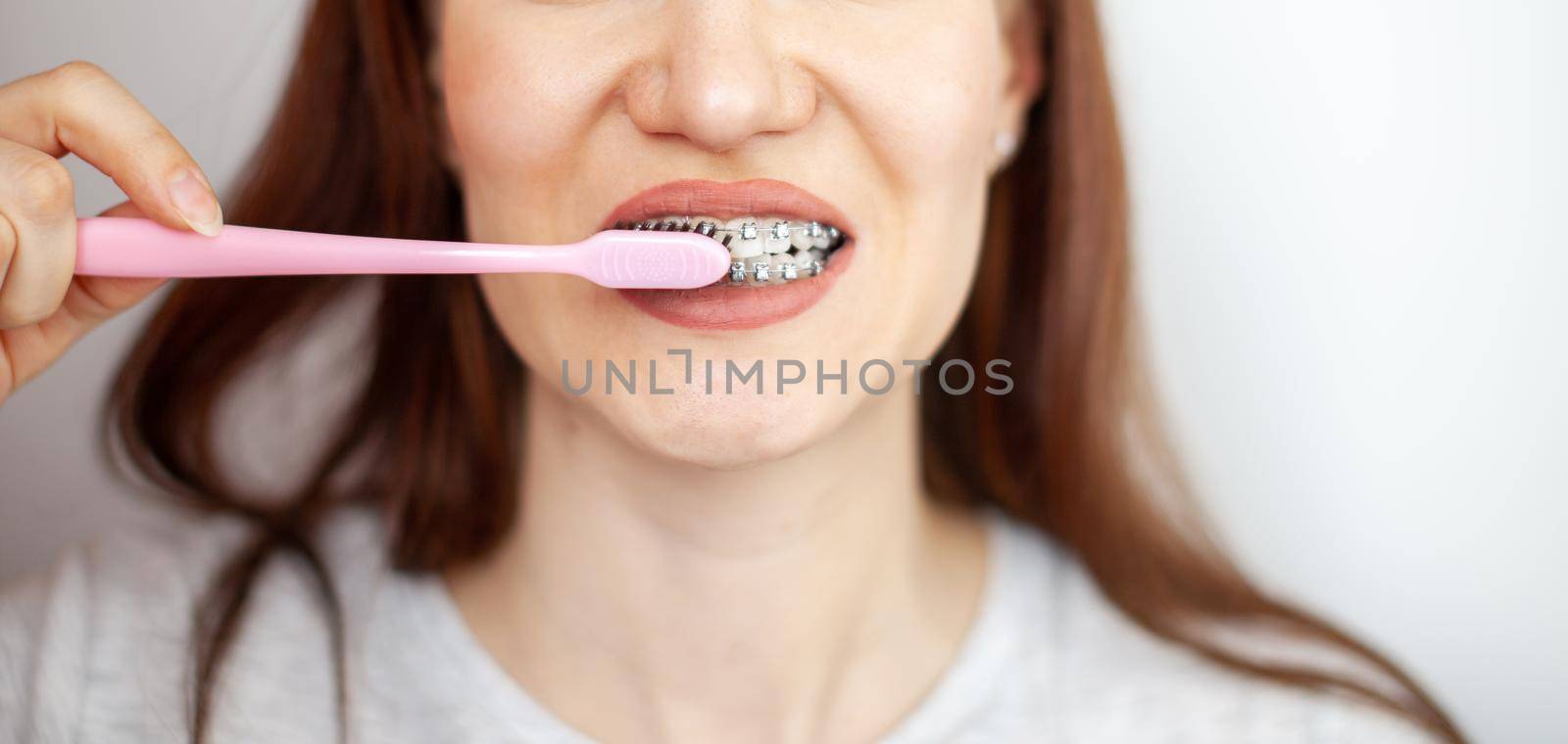 A girl with braces on her white teeth is brushing her teeth with a toothbrush. Straightening and dental hygiene. Dental care.