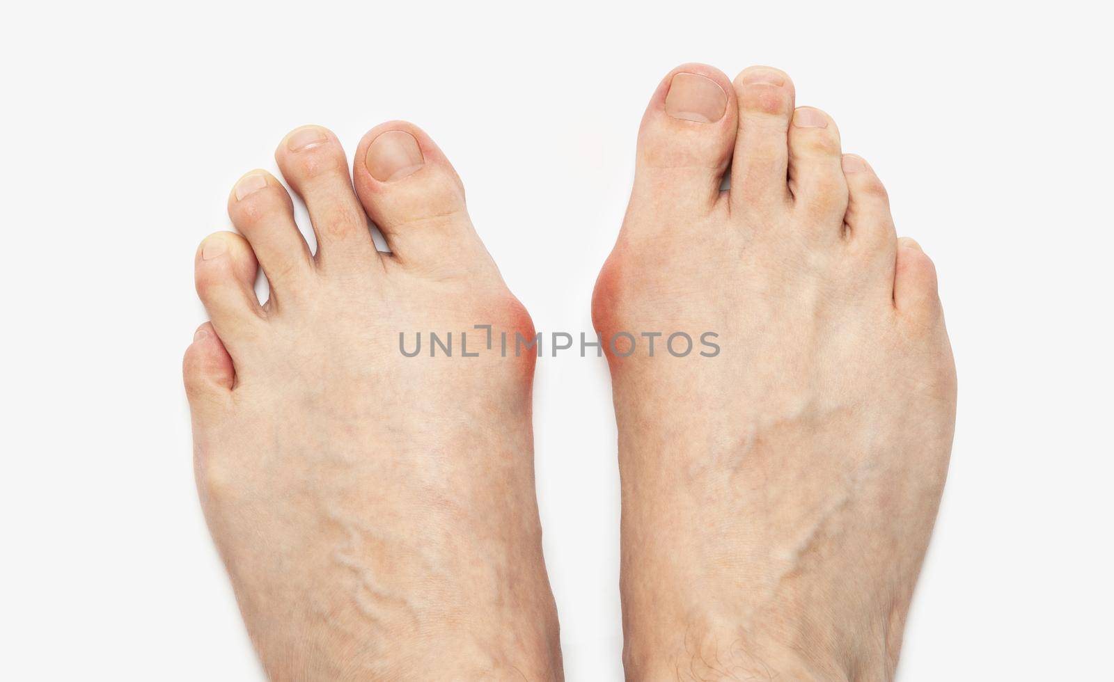 Varus valgus and Hallux valgus, bunion on white background by SlayCer