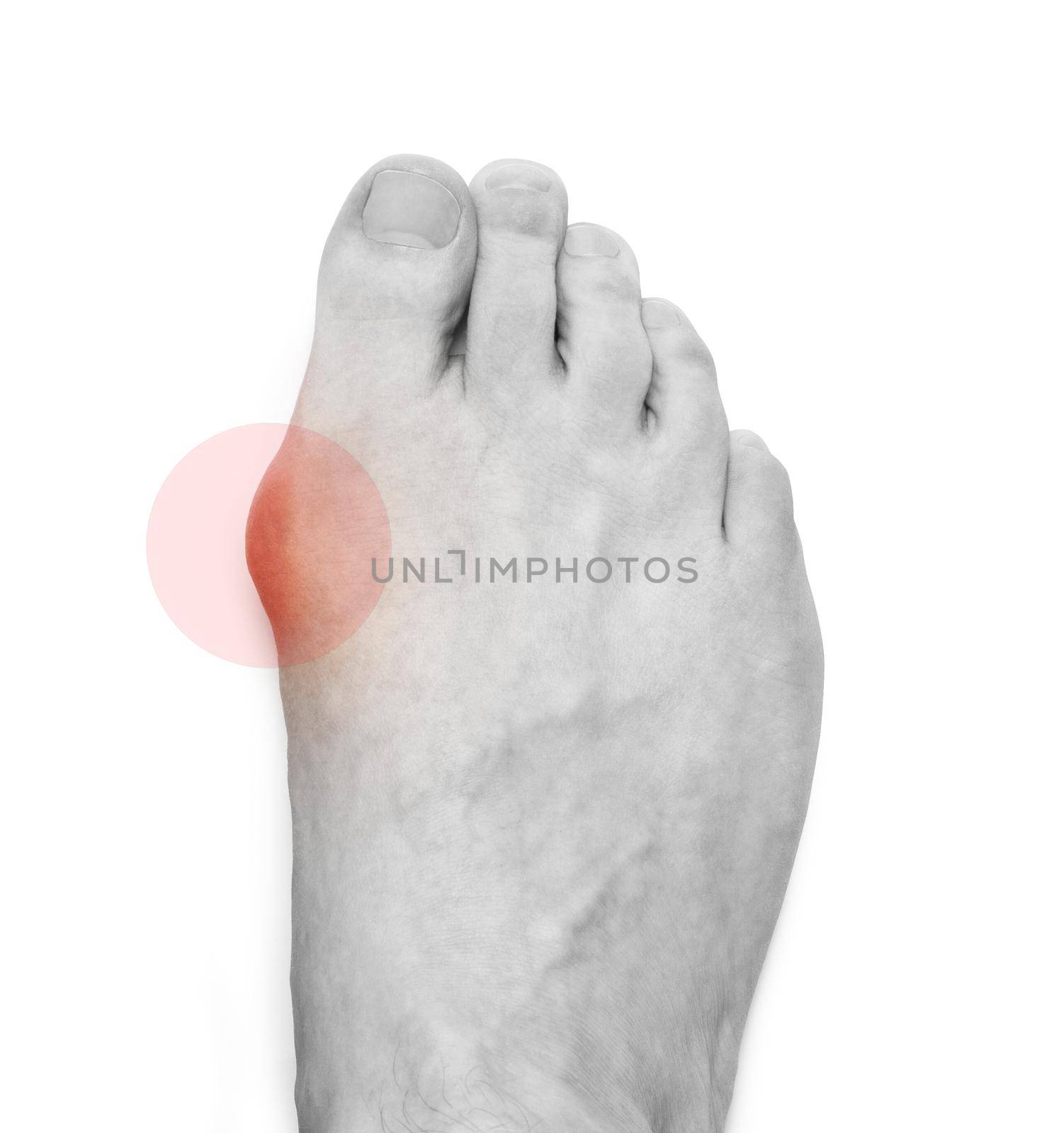 Varus valgus and Hallux valgus, bunion on white background by SlayCer