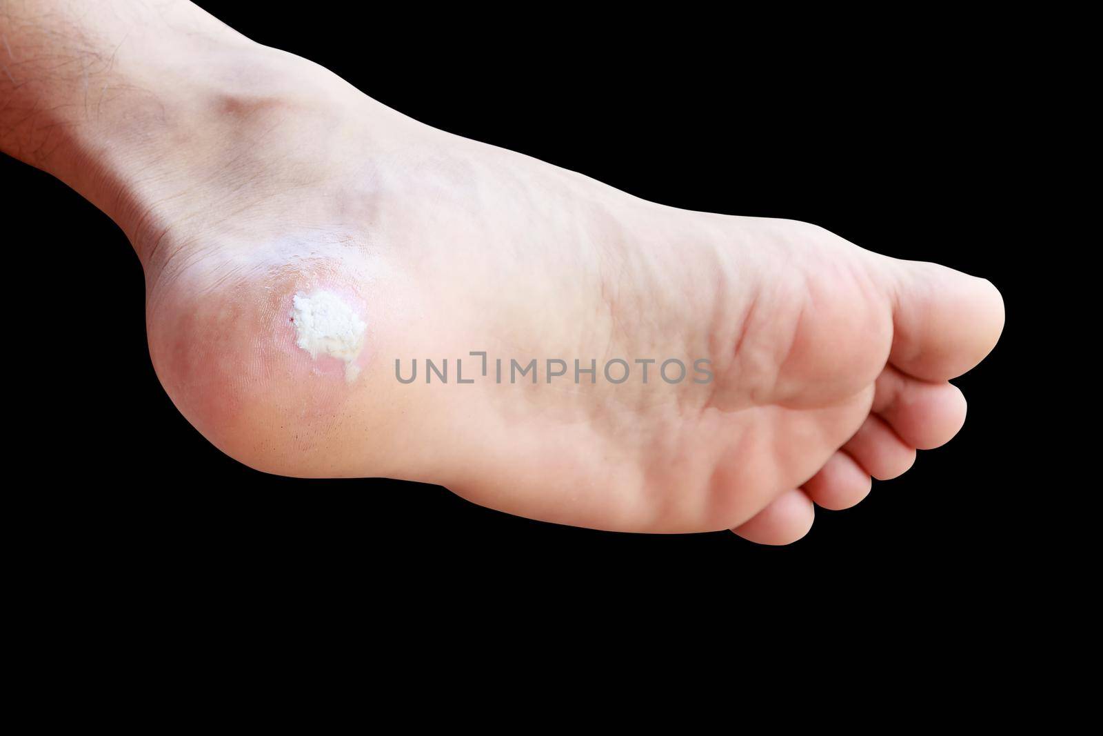 close up pain foot corn isolated on black background with clipping path