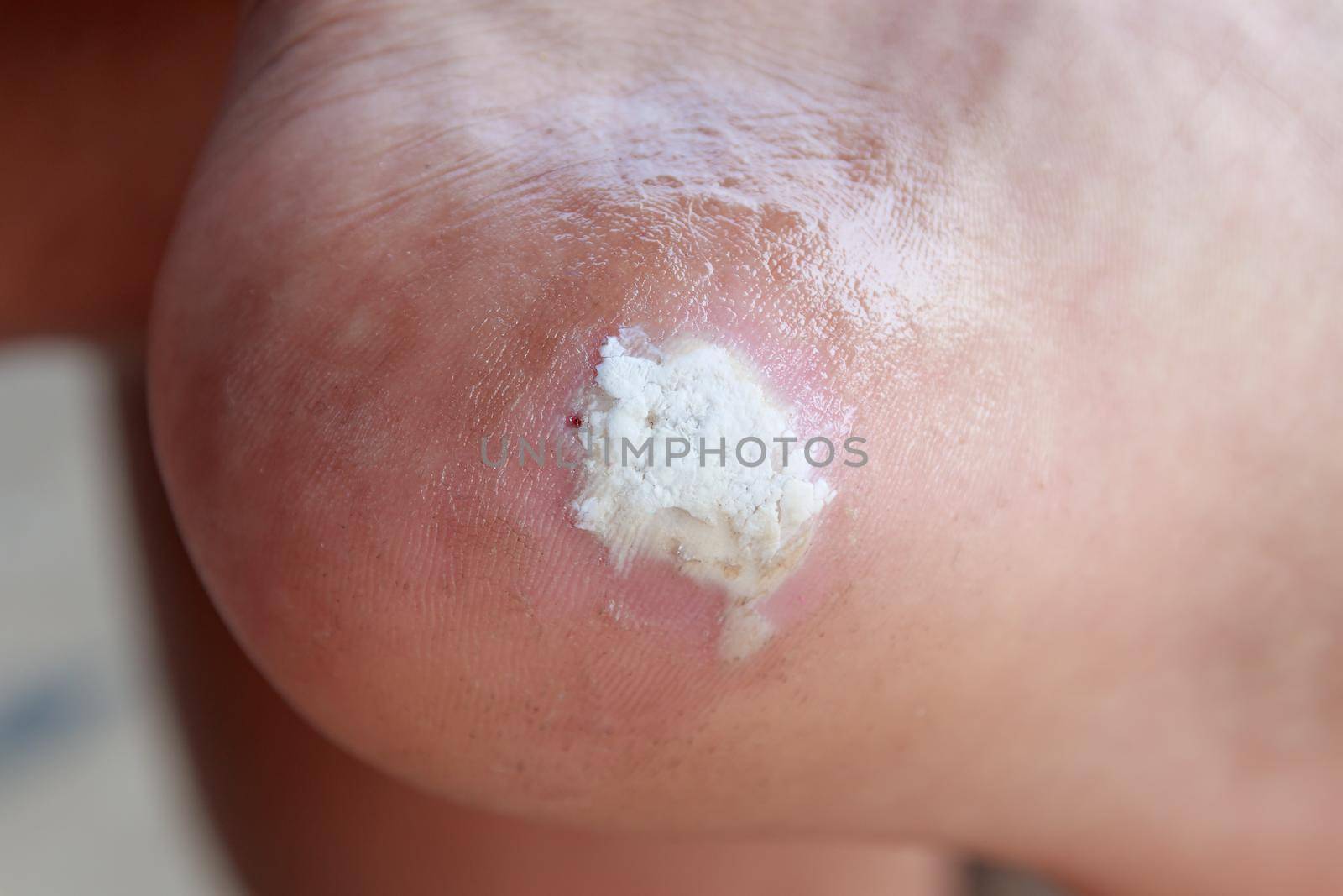 close up pain foot cornฃ by pramot