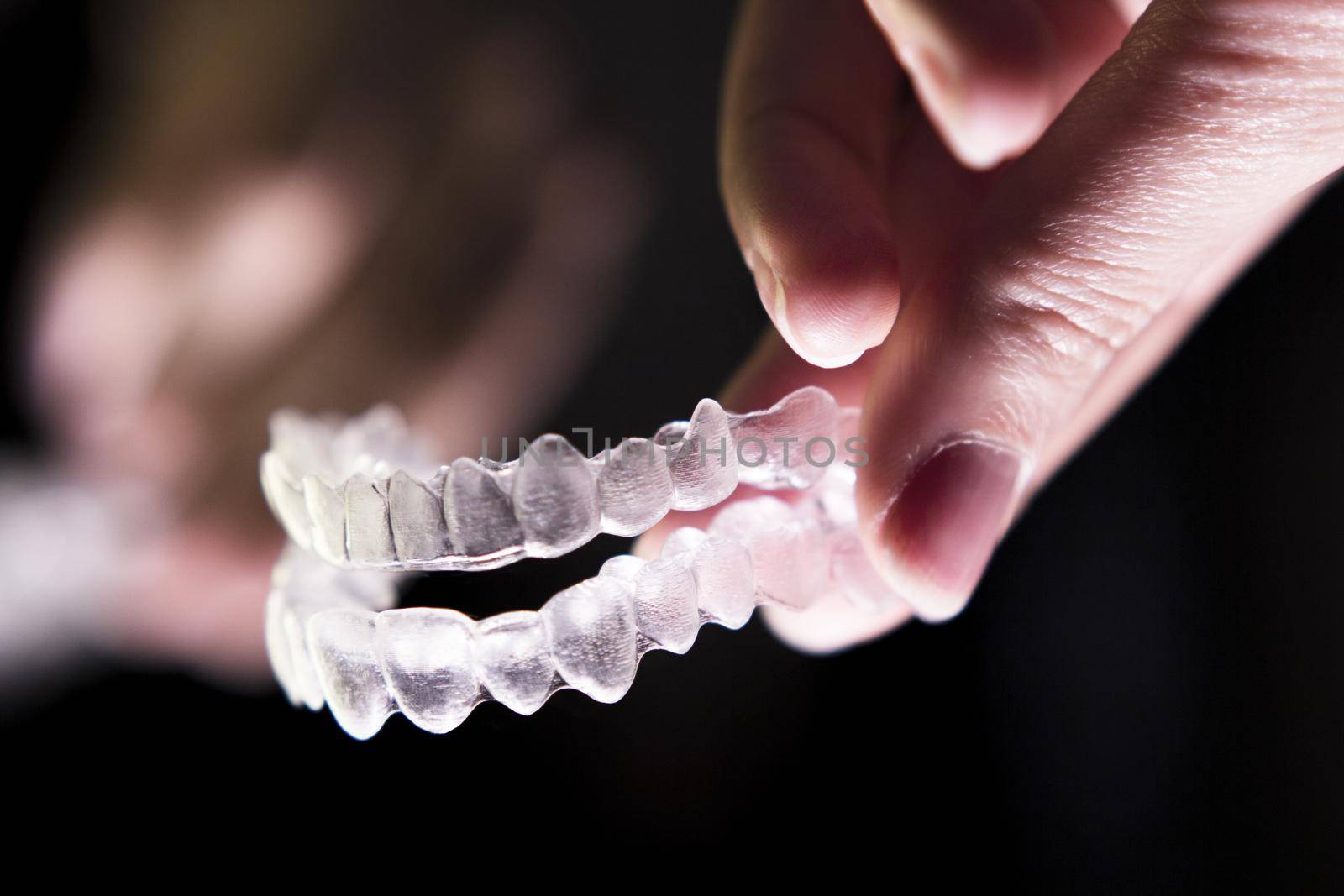 Transparent ferule retainer teeth alignment by GemaIbarra