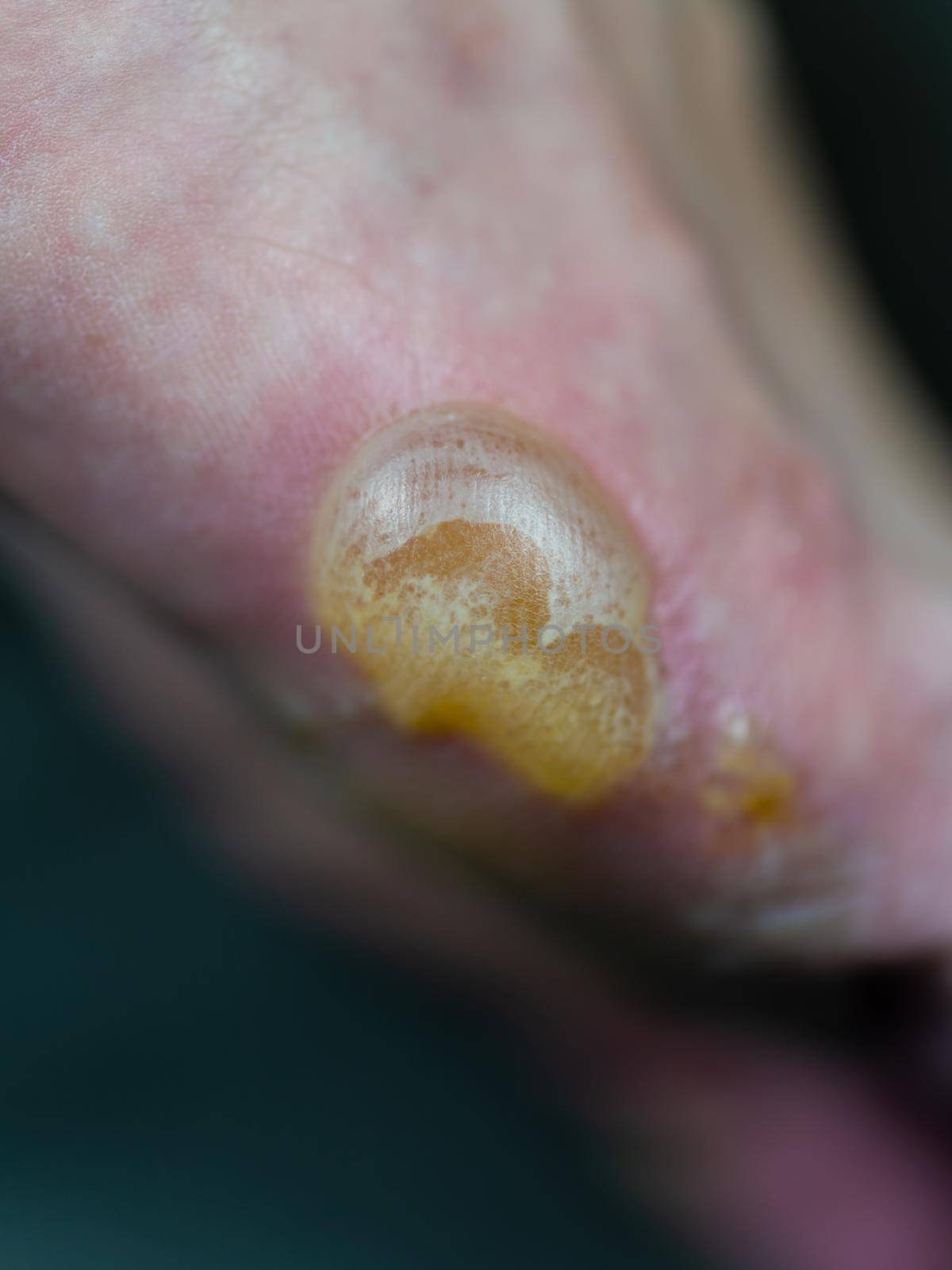 Big blister on foot from Pompholyx eczema by imagesbykenny