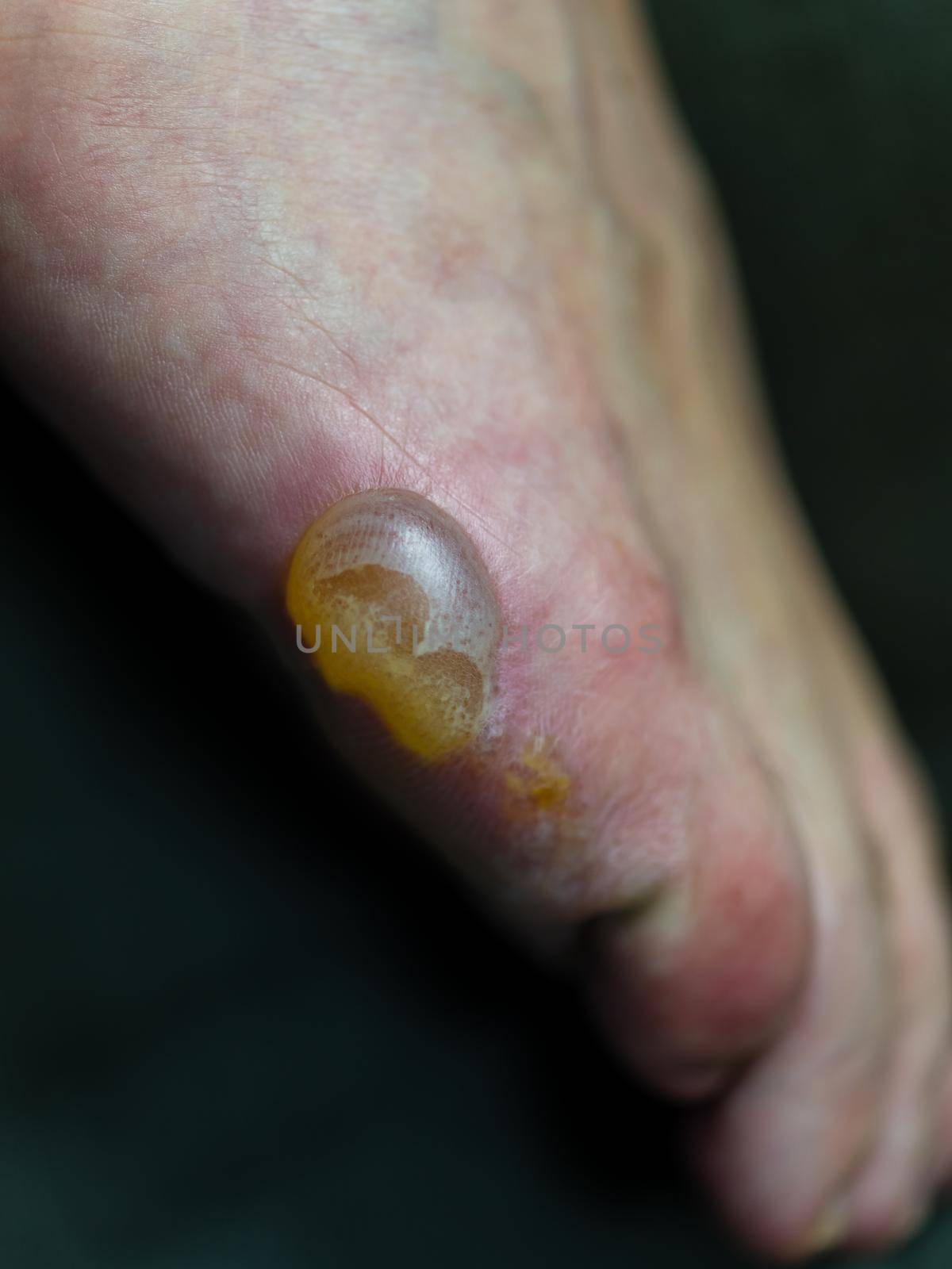 Big blister and flaking skin on foot from Pompholyx eczema