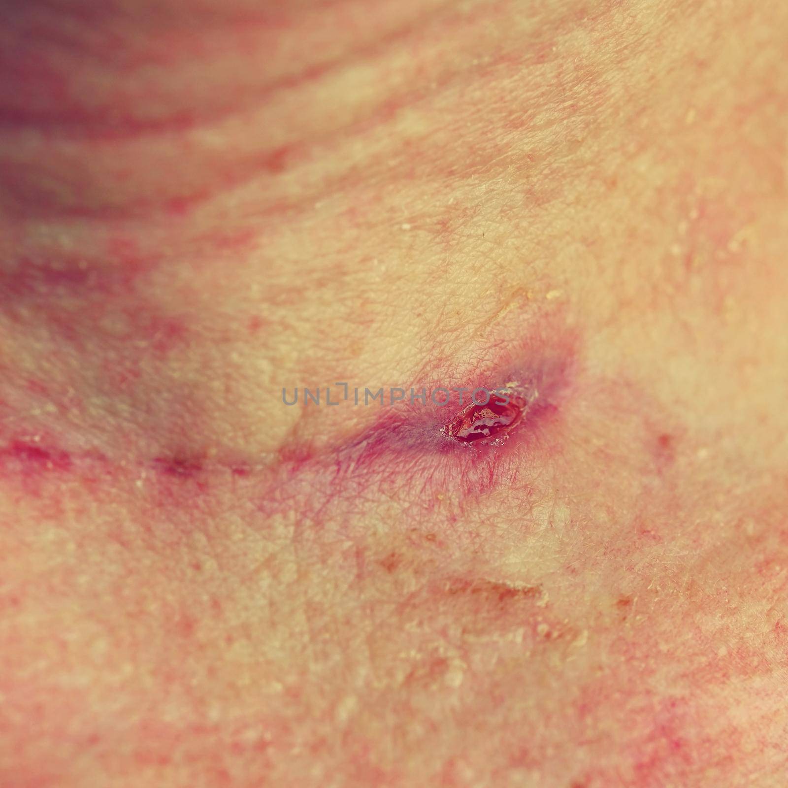 Freshly healed scar on the neck after thyroid surgery. by Montypeter