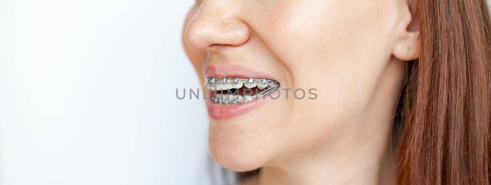 The woman smiles, showing her white teeth with braces. Even teeth from wearing braces. The concept of a dentist and an orthodontist.