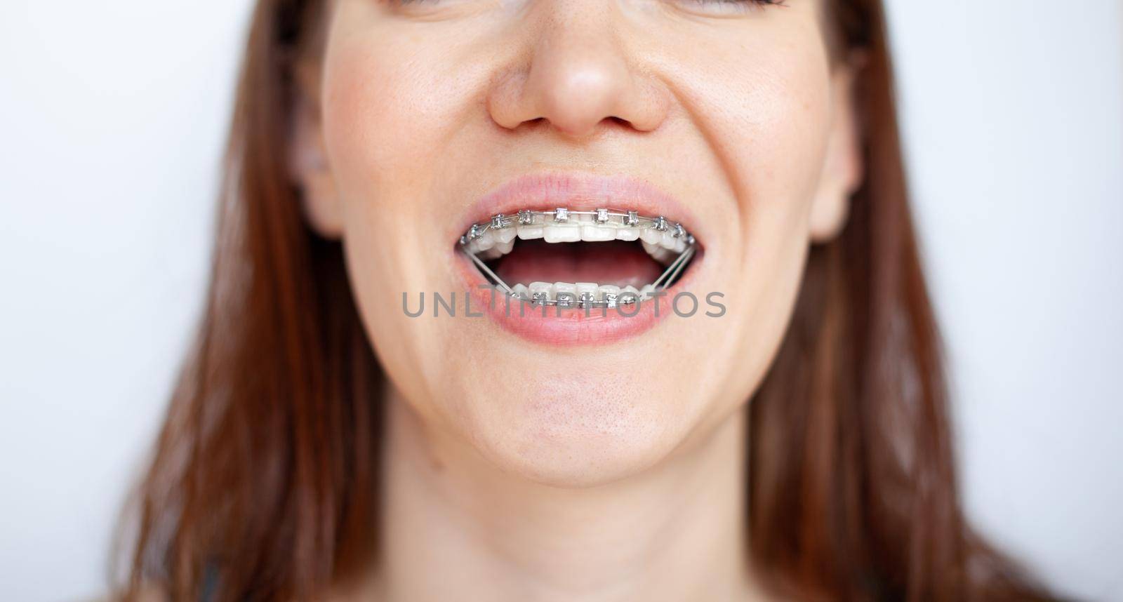 The woman smiles, showing her white and even teeth with braces. by AnatoliiFoto